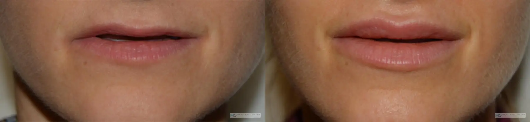 Injectables: Patient 2 - Before and After  