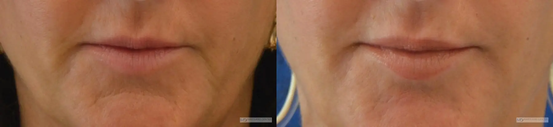 Injectables: Patient 3 - Before and After  