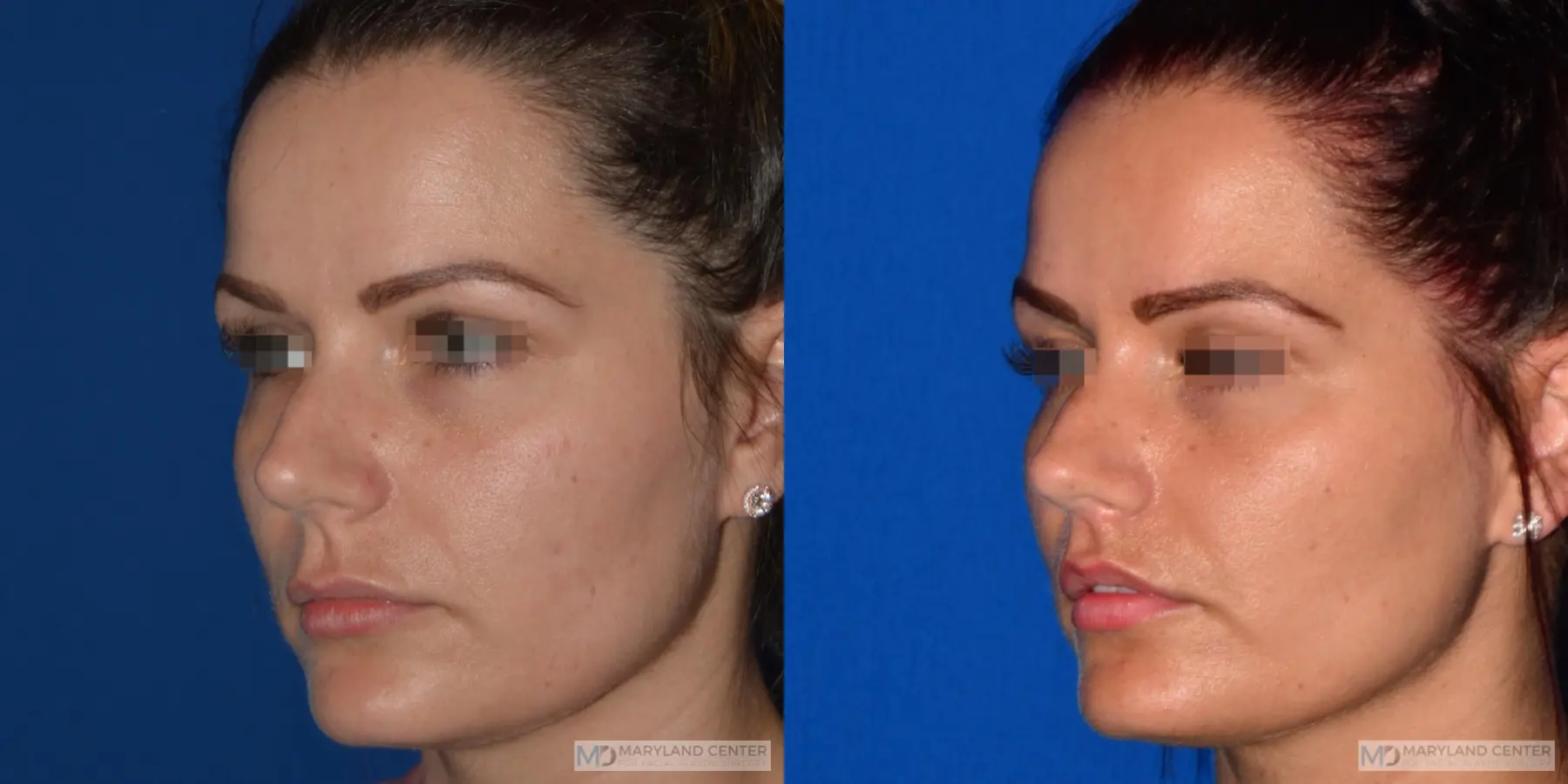 Lip Lift: Patient 2 - Before and After 3