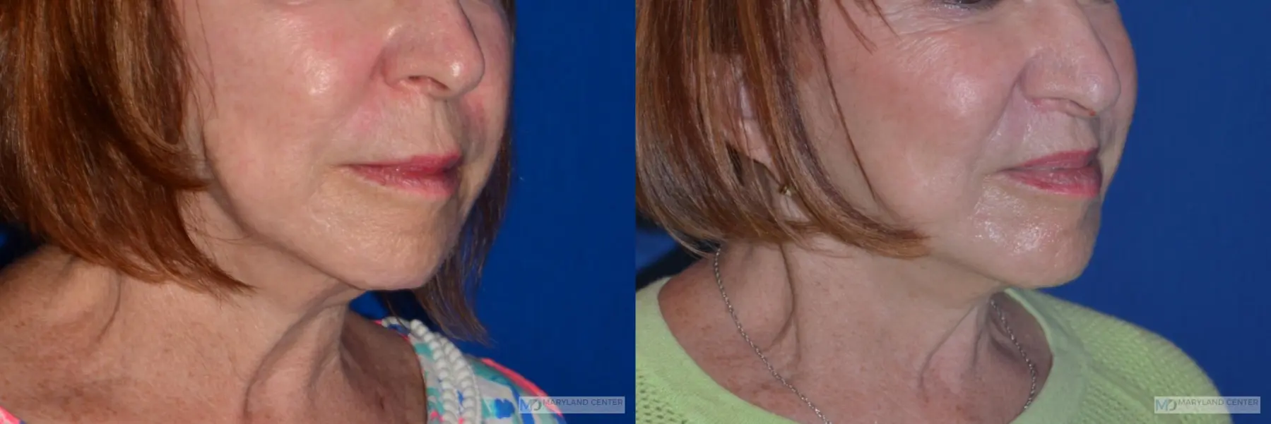 Lip Lift: Patient 1 - Before and After 2