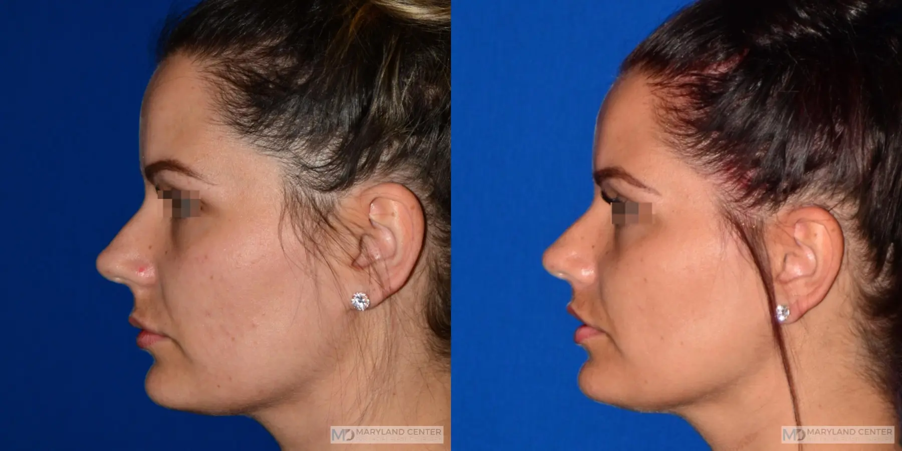 Lip Lift: Patient 2 - Before and After 2