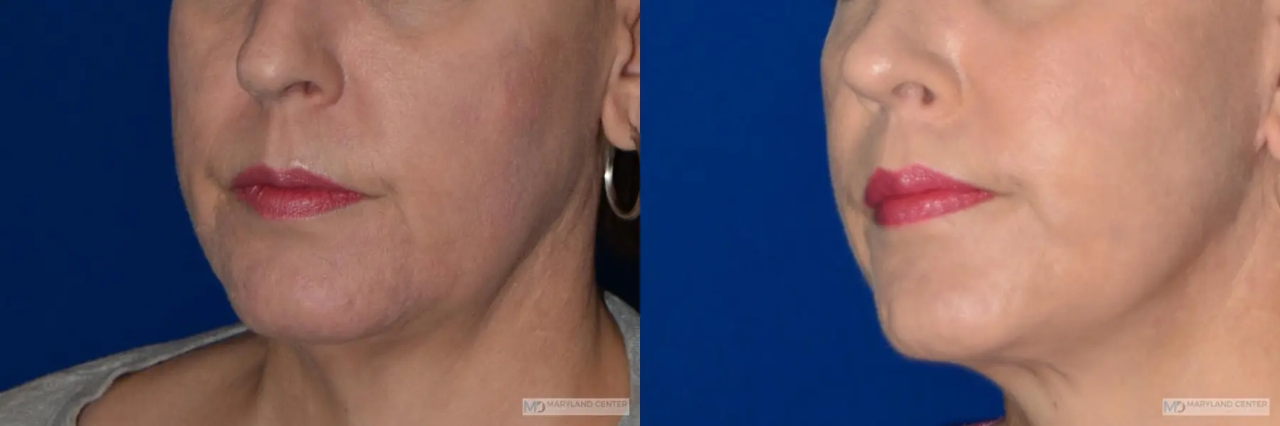 Lip Lift: Patient 3 - Before and After 2