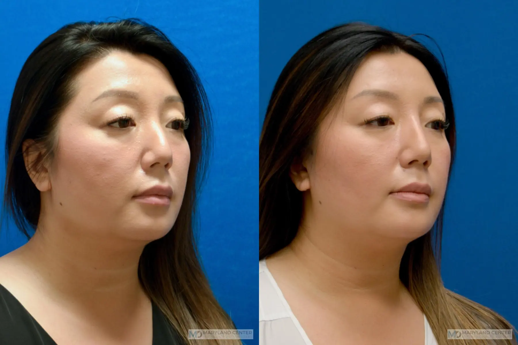 Liquid Rhinoplasty: Patient 2 - Before and After  
