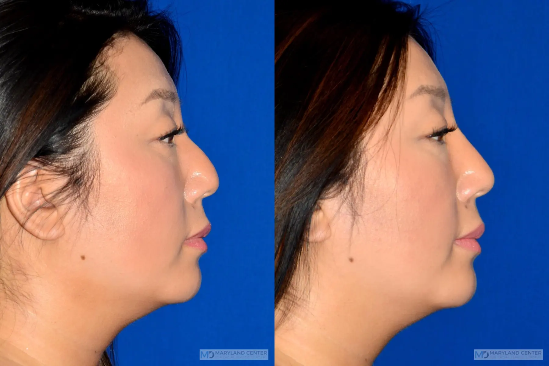 Liquid Rhinoplasty: Patient 2 - Before and After 2