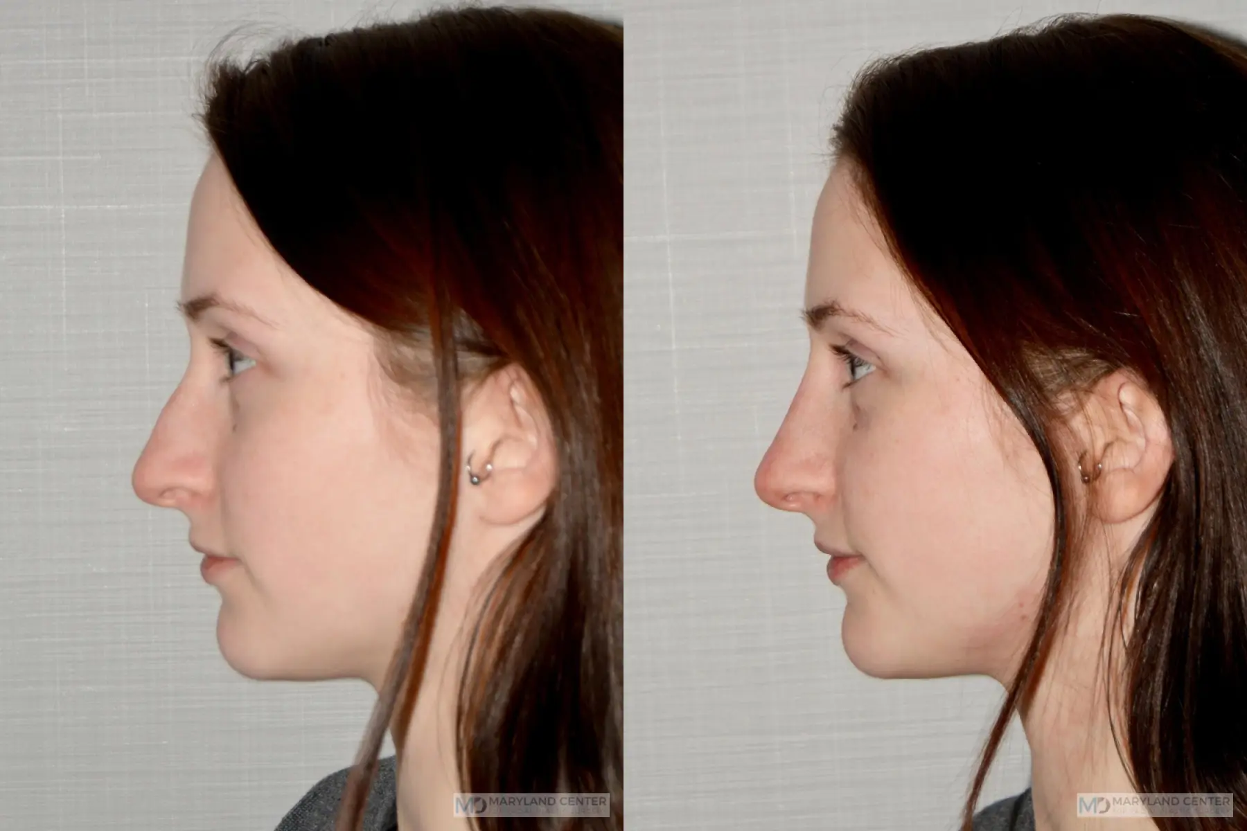 Liquid Rhinoplasty: Patient 3 - Before and After 5