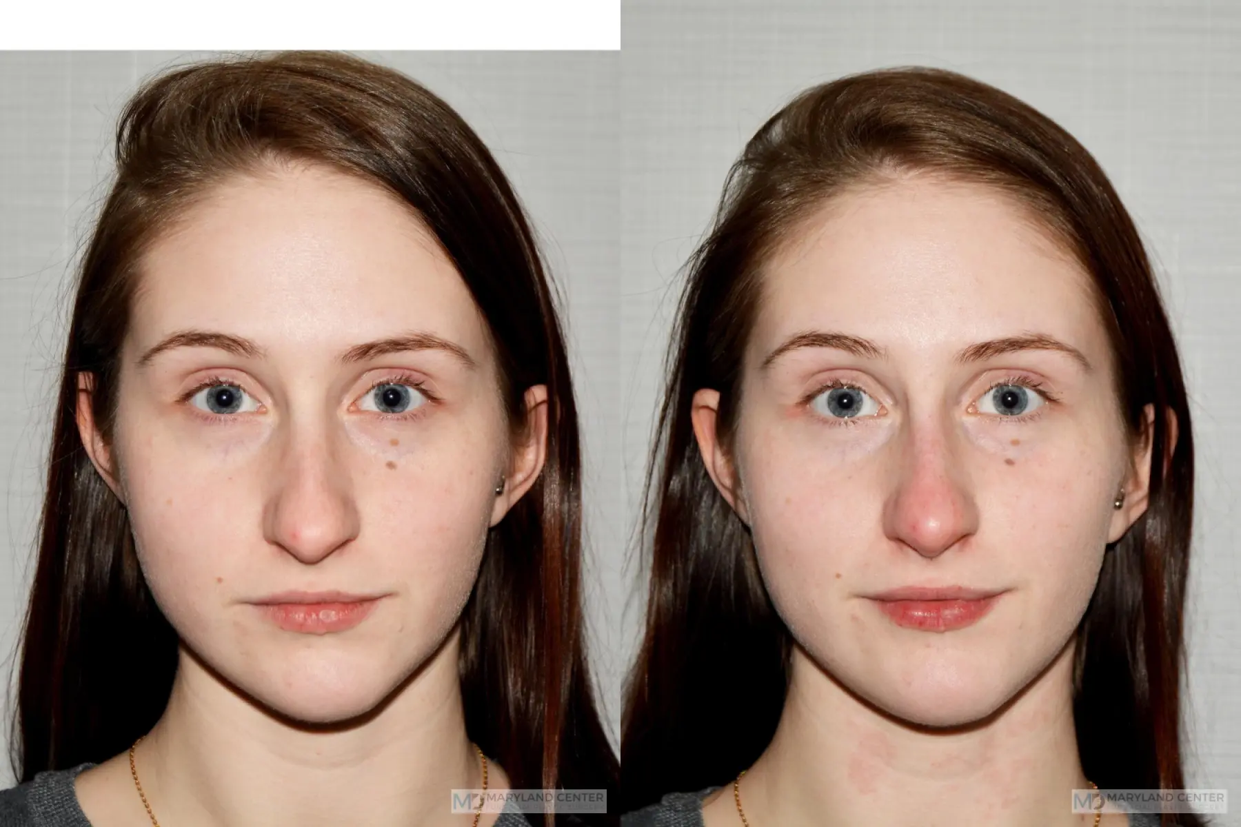 Liquid Rhinoplasty: Patient 3 - Before and After  