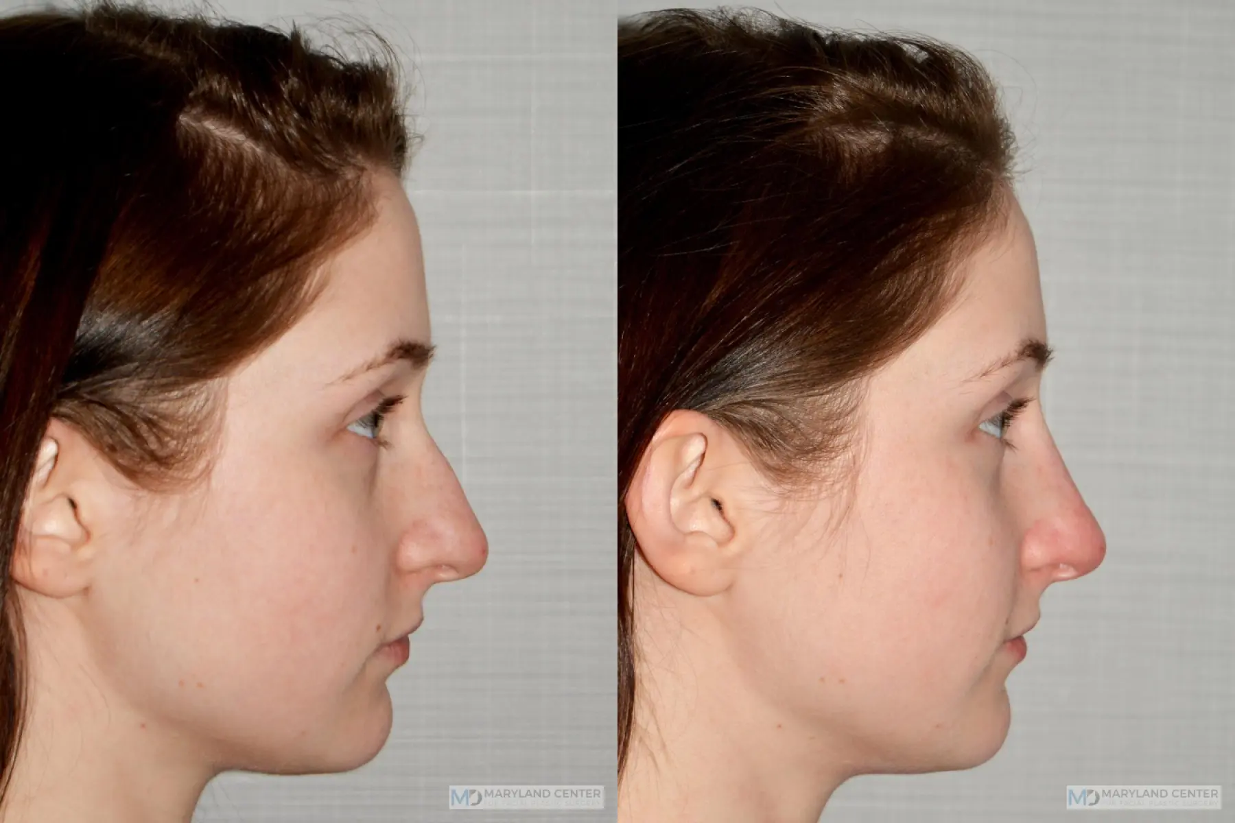 Liquid Rhinoplasty: Patient 3 - Before and After 3