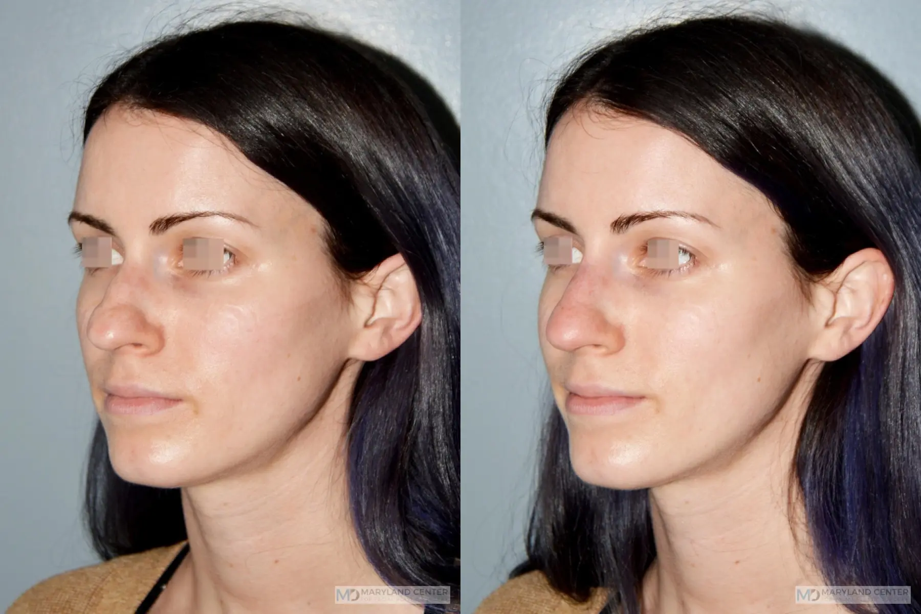 Liquid Rhinoplasty: Patient 1 - Before and After 2