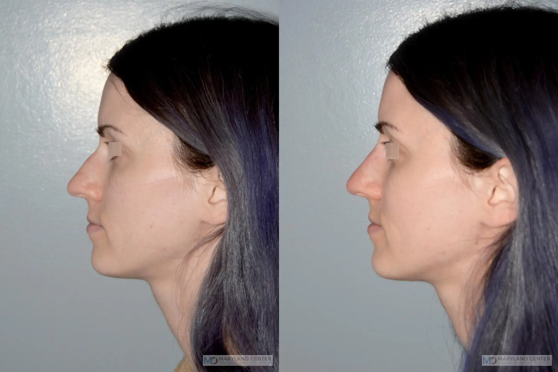 Liquid Rhinoplasty: Patient 1 - Before and After  