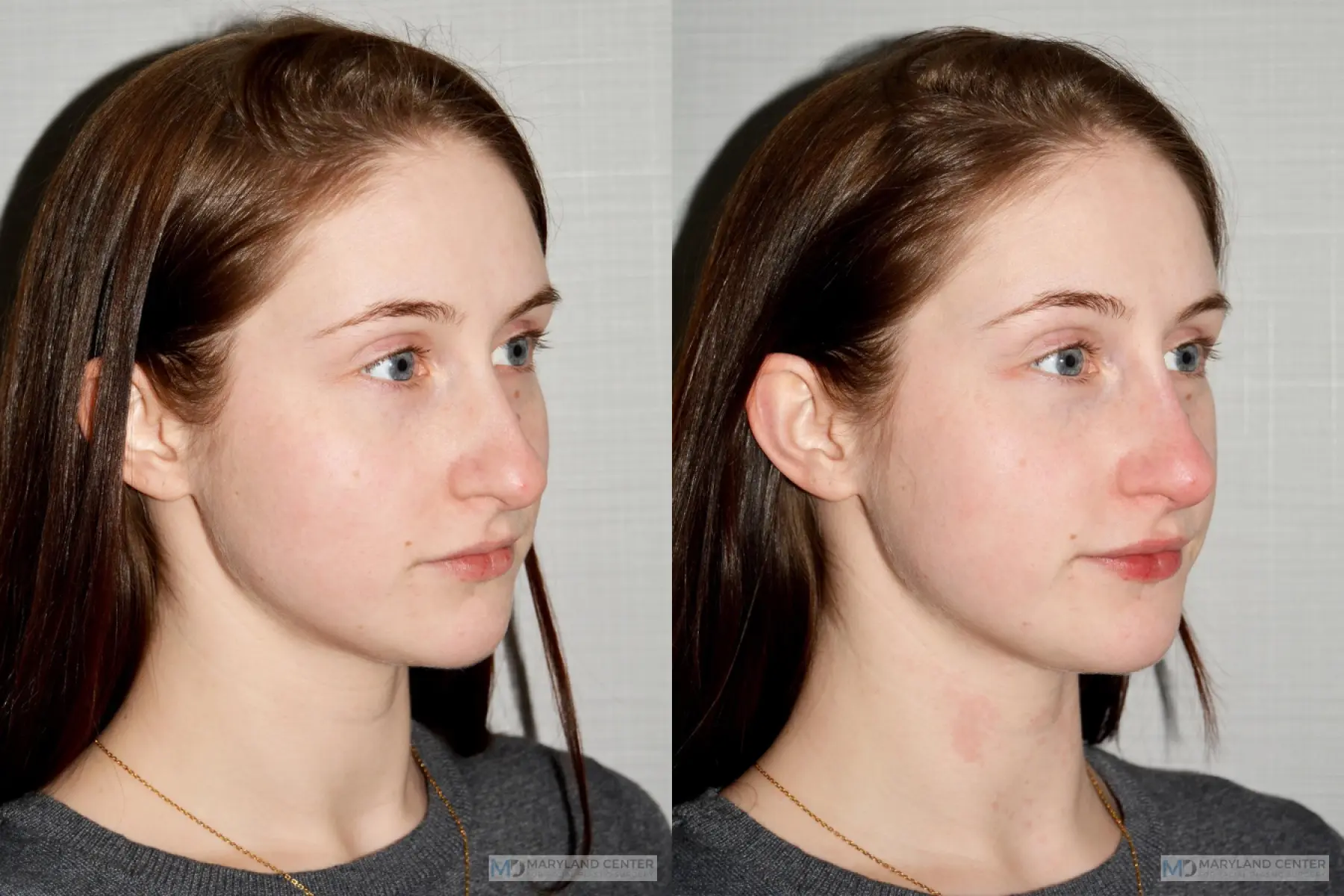 Liquid Rhinoplasty: Patient 3 - Before and After 2