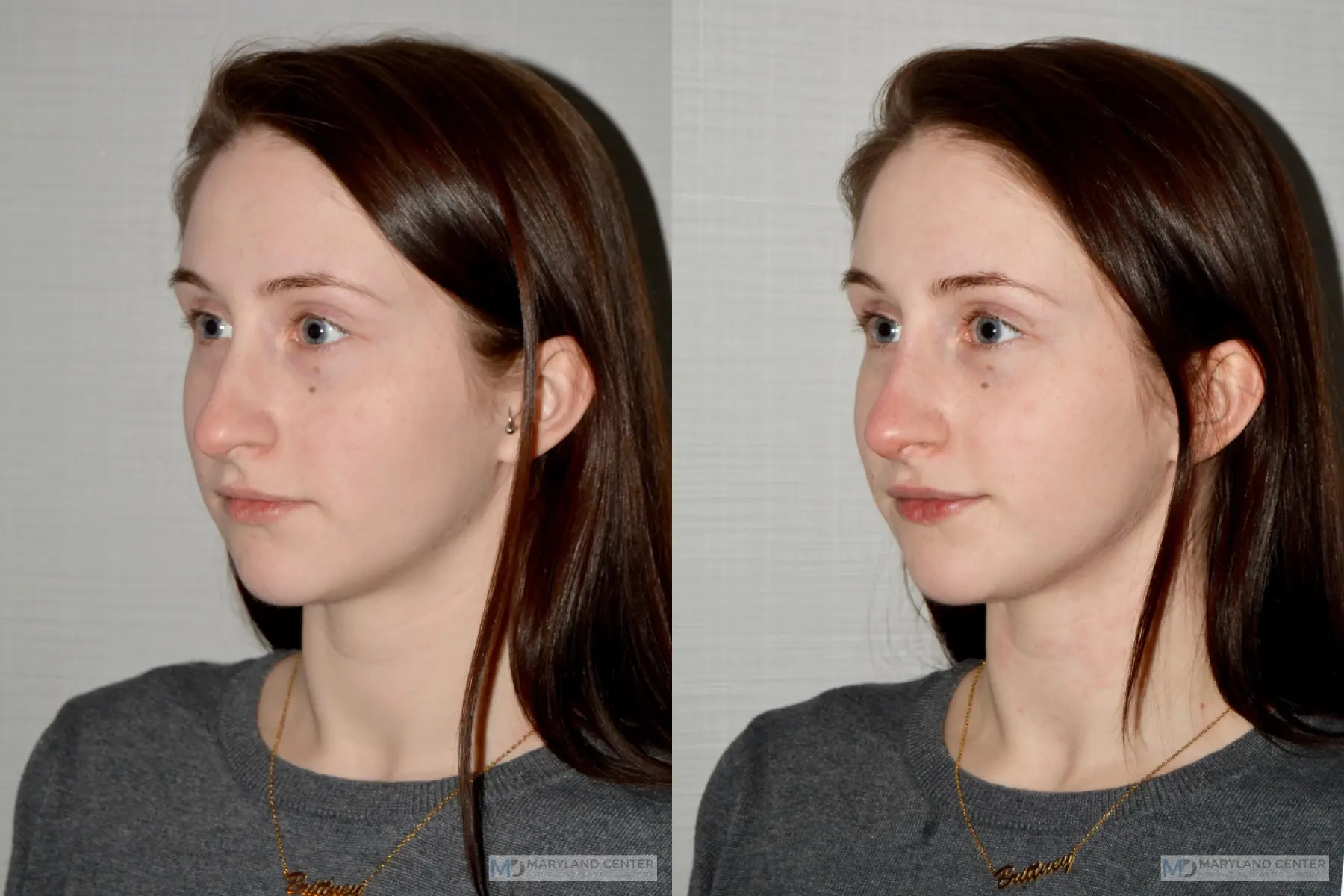 Liquid Rhinoplasty: Patient 3 - Before and After 4