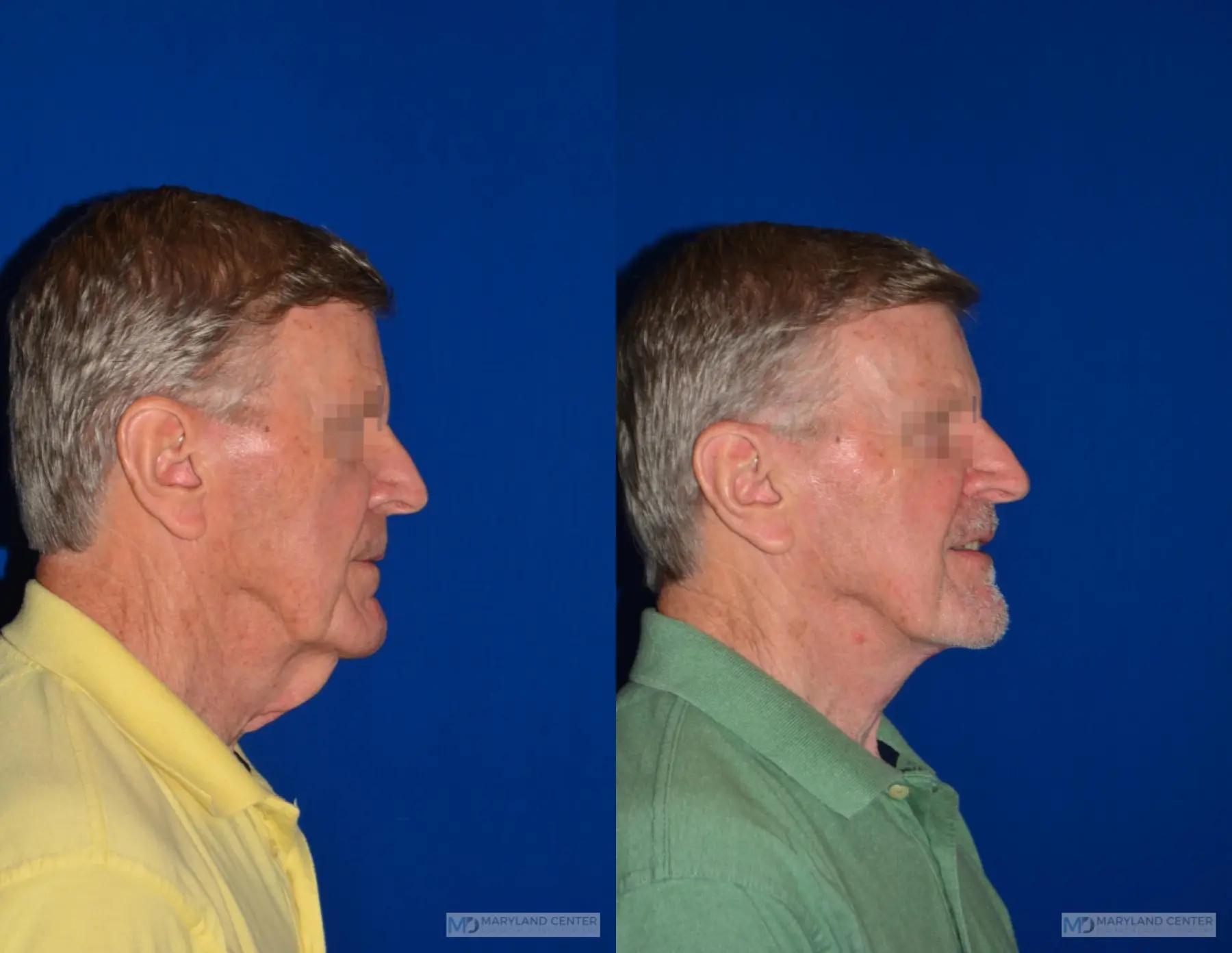 Neck Lift: Patient 3 - Before and After 2