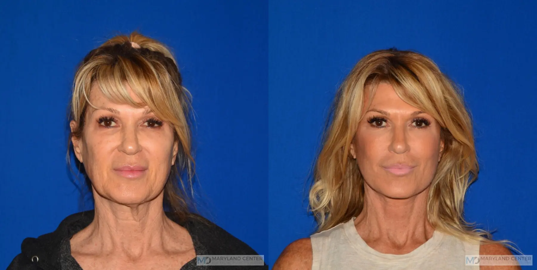 Neck Lift: Patient 5 - Before and After  