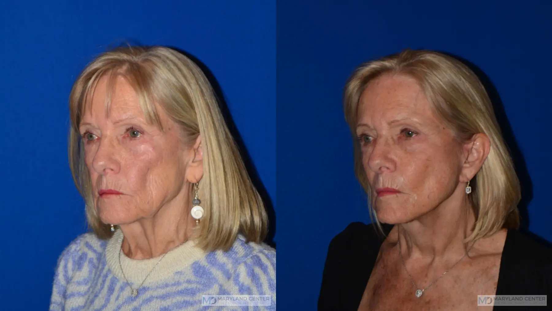 Neck Lift: Patient 4 - Before and After 5