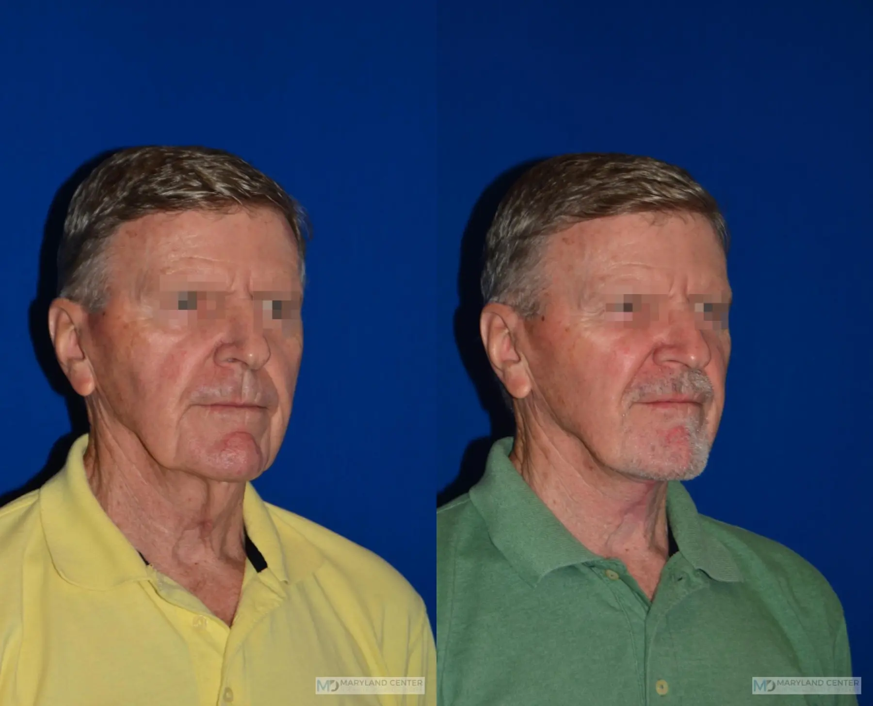 Neck Lift: Patient 3 - Before and After 3