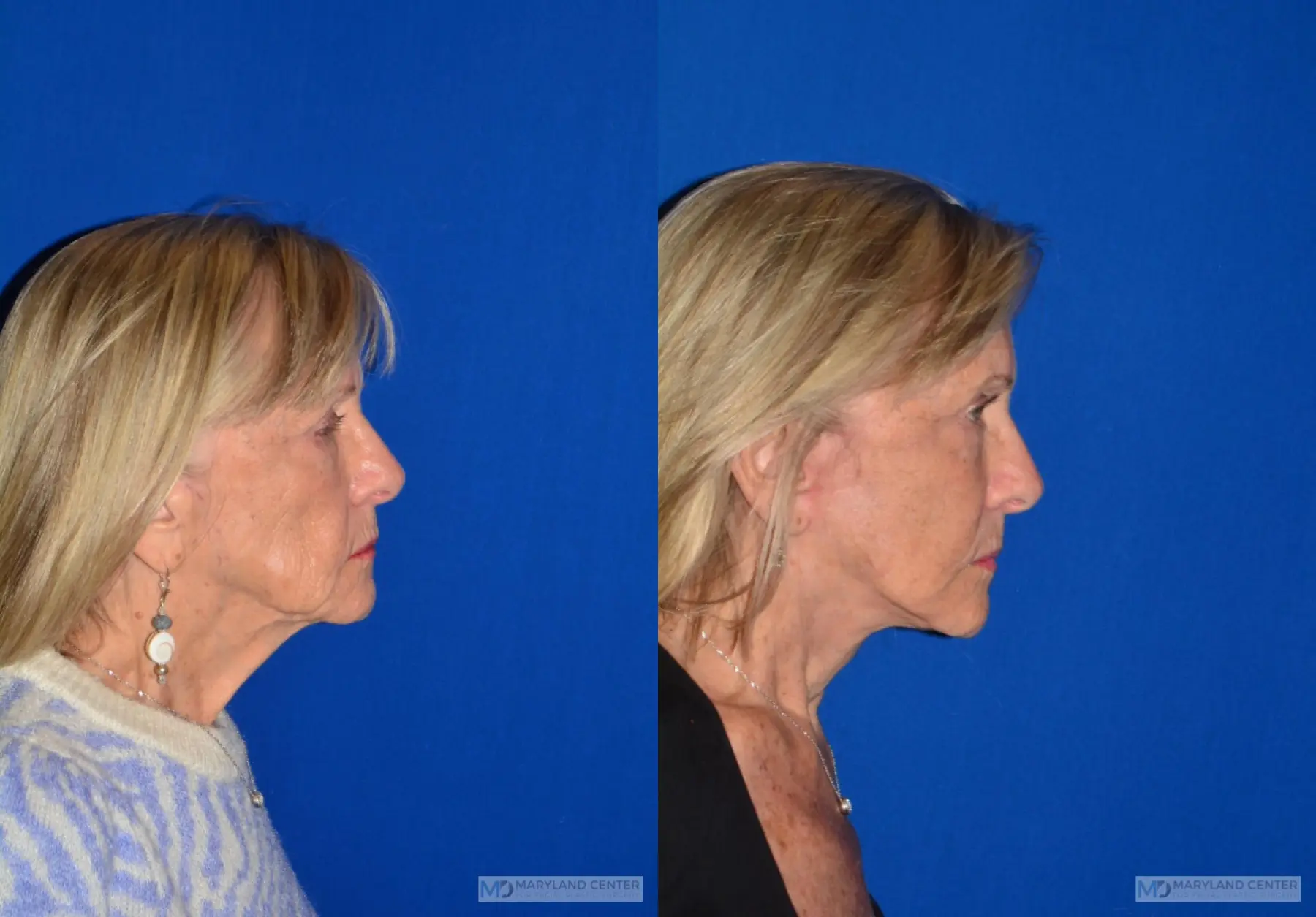 Neck Lift: Patient 4 - Before and After 2