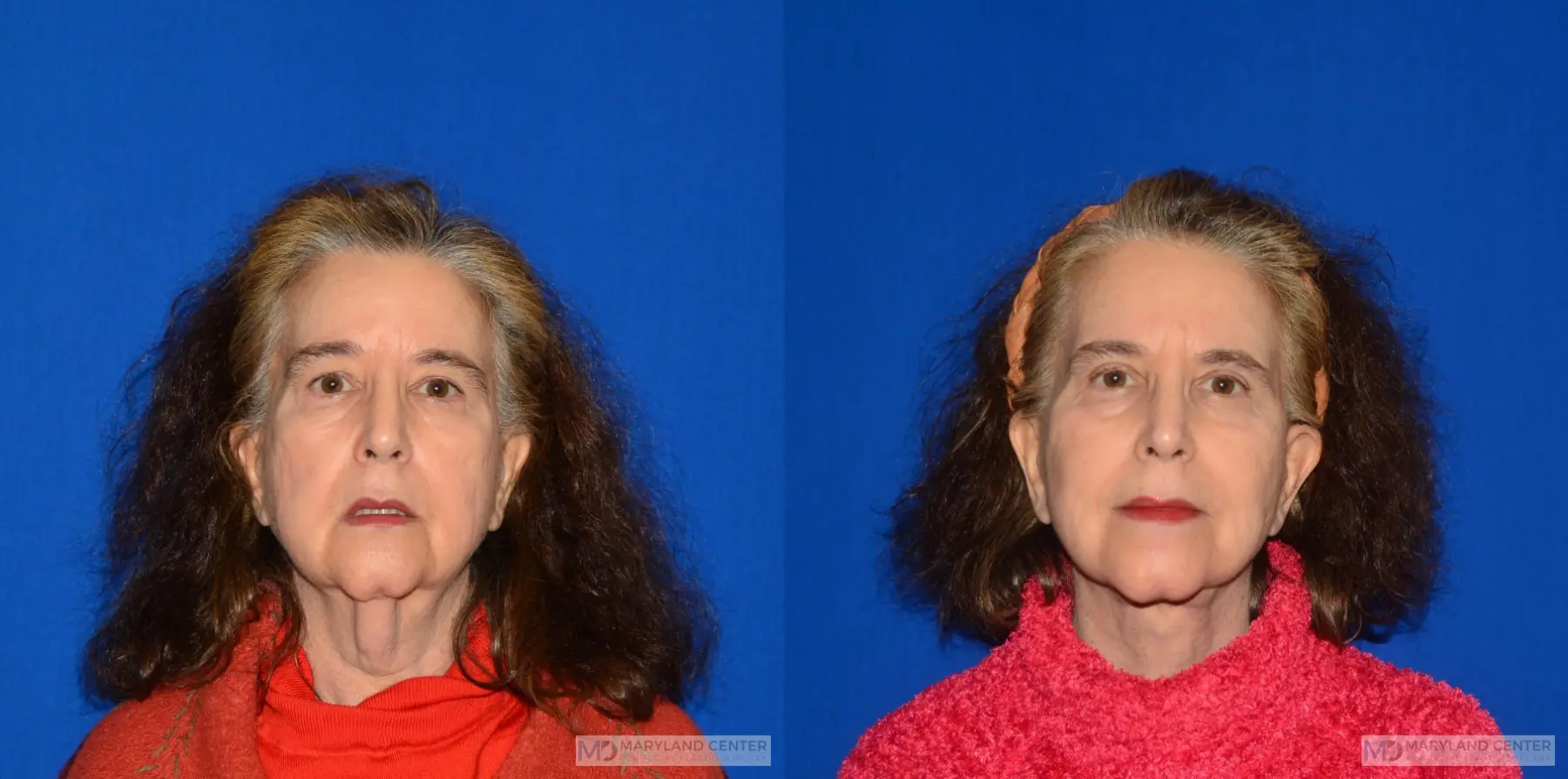 Neck Lift: Patient 2 - Before and After  