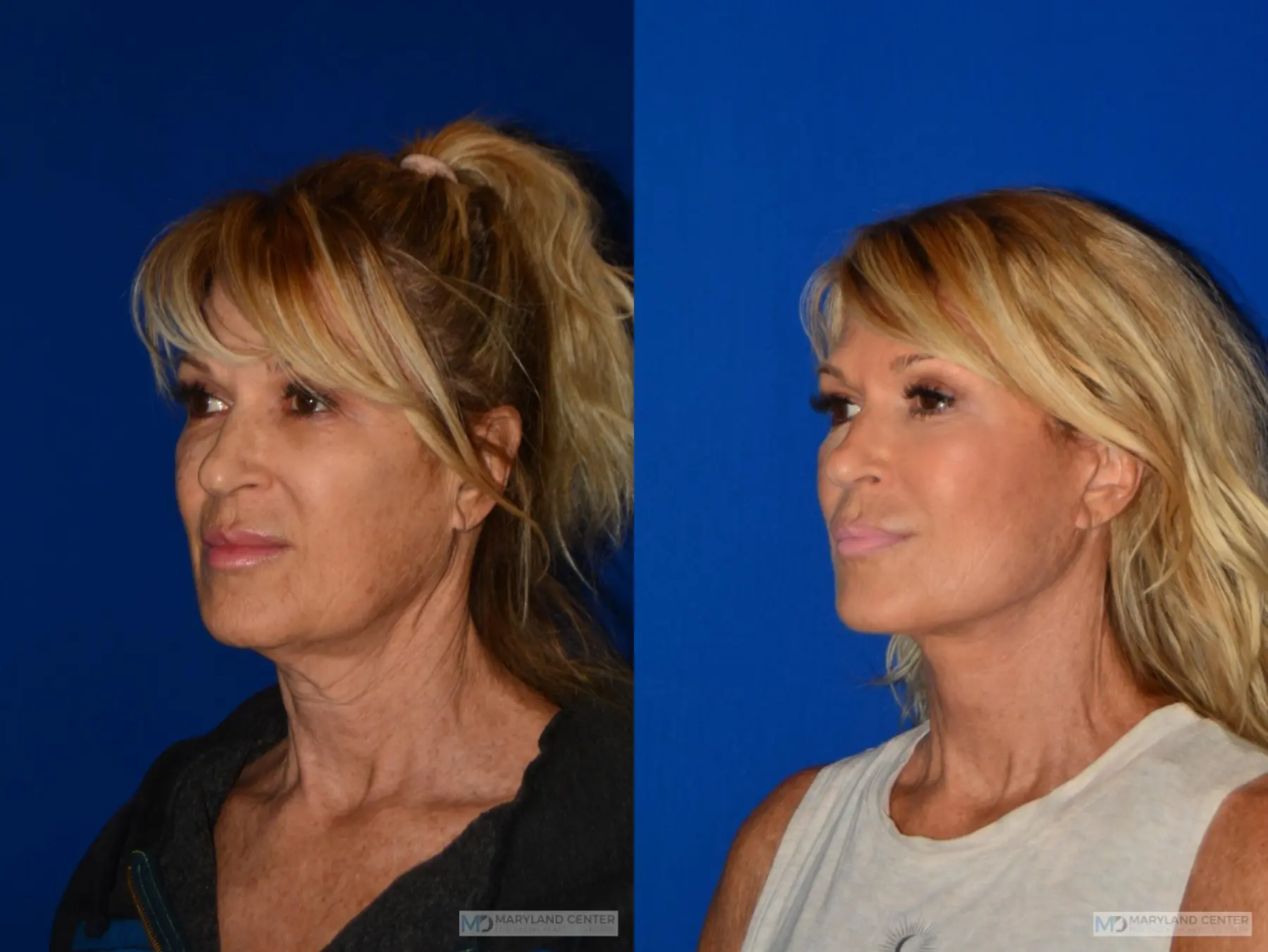 Neck Lift: Patient 5 - Before and After 5