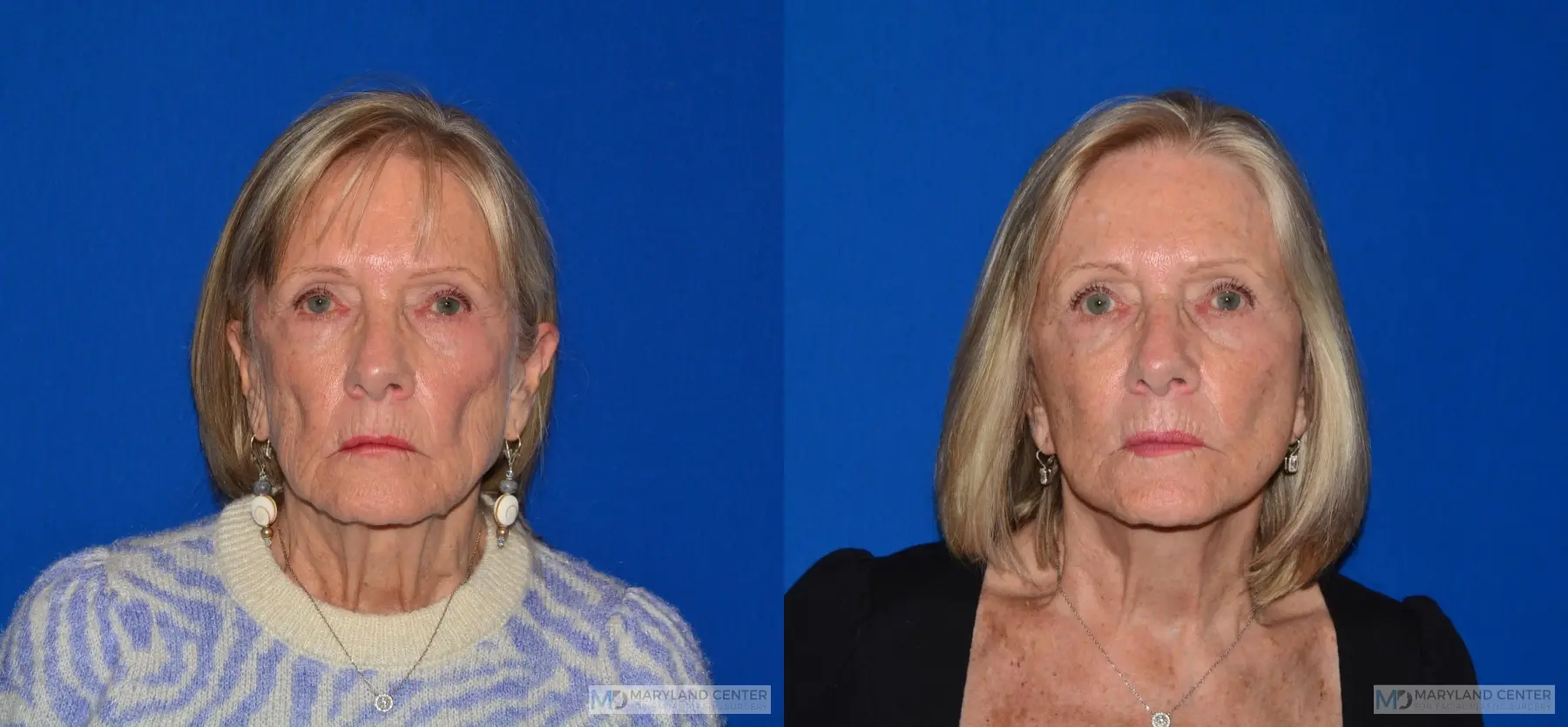 Neck Lift: Patient 4 - Before and After  