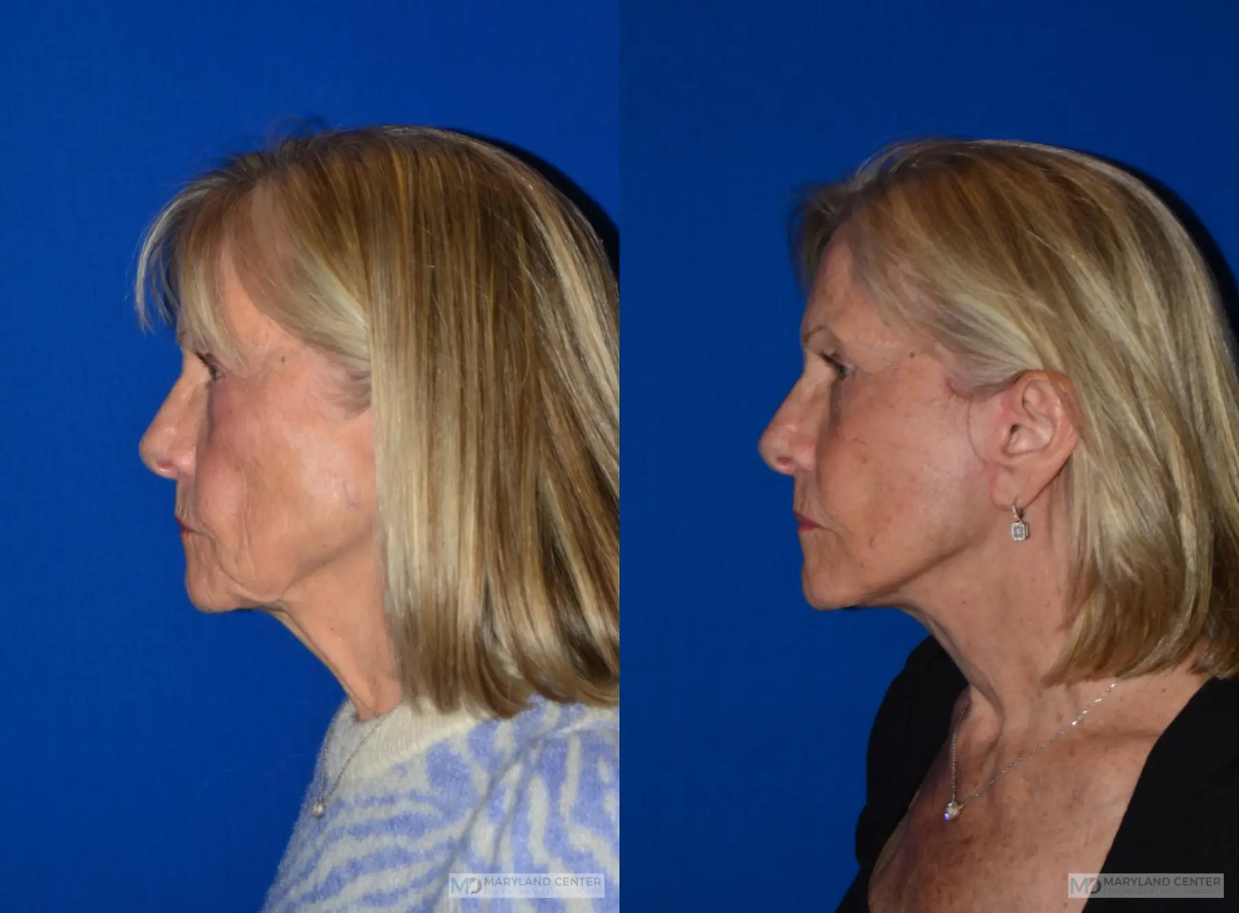 Neck Lift: Patient 4 - Before and After 4