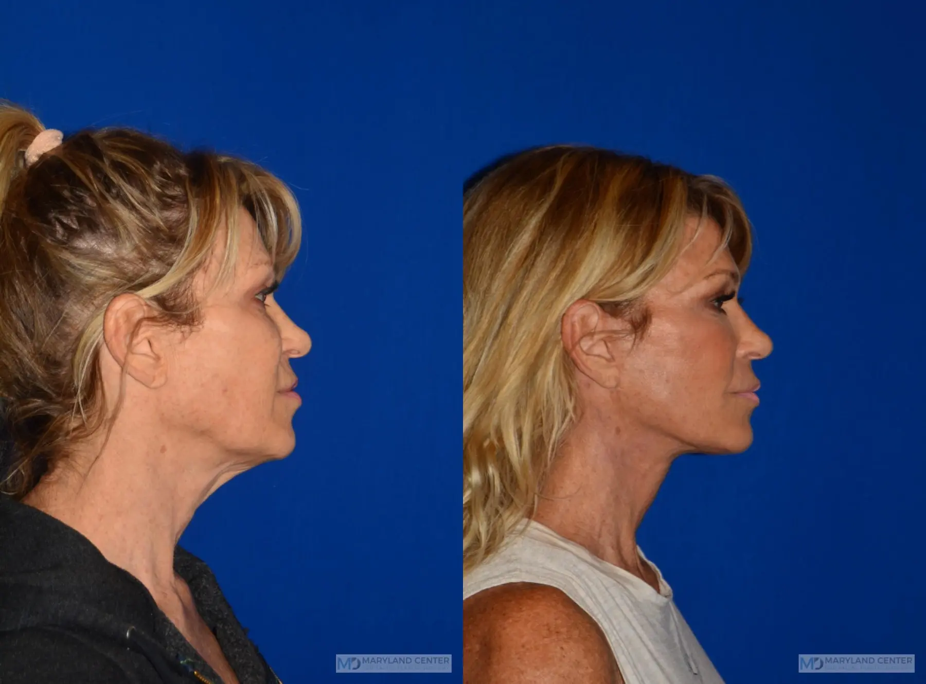 Neck Lift: Patient 5 - Before and After 2