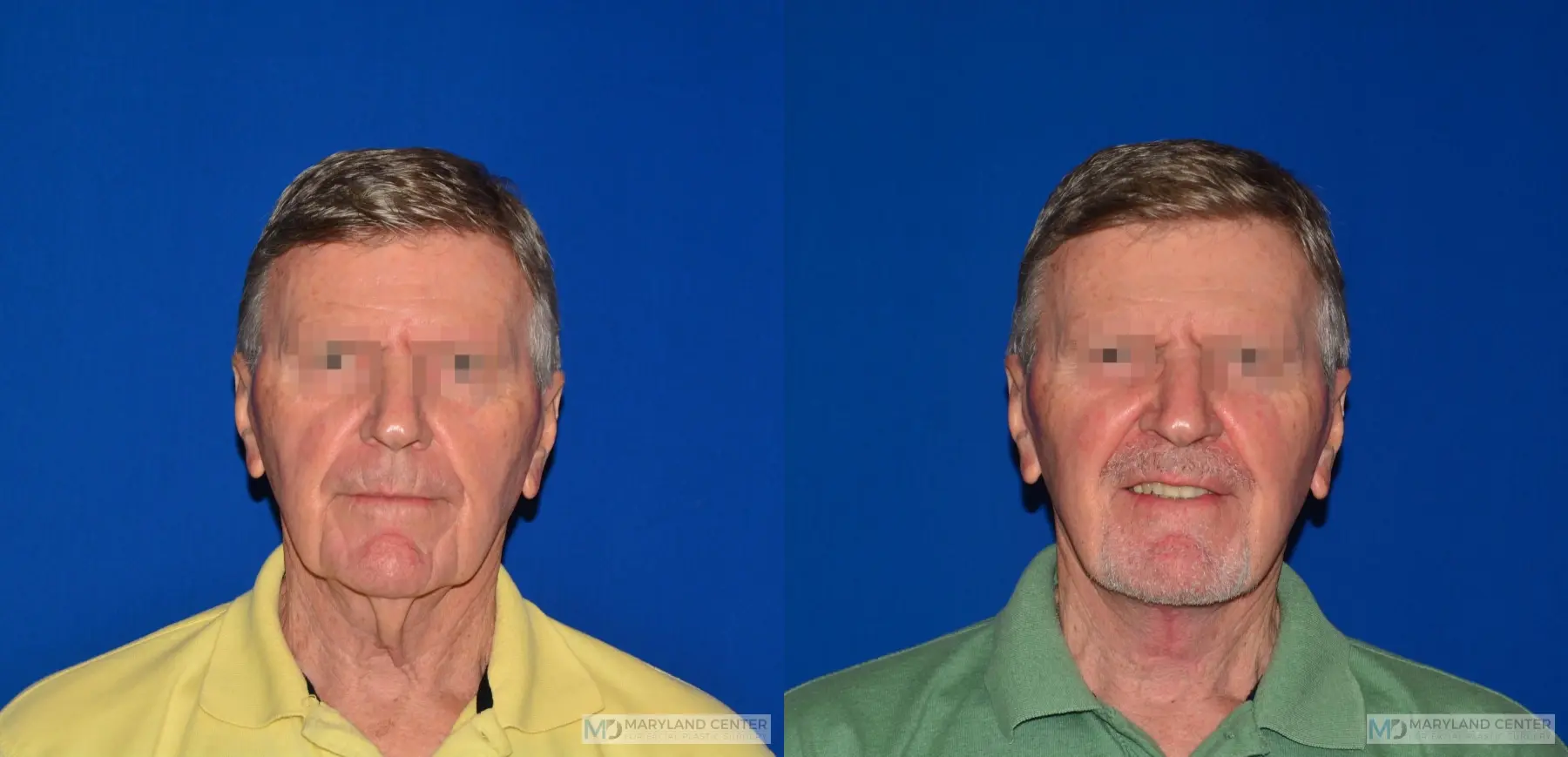 Neck Lift: Patient 3 - Before and After  