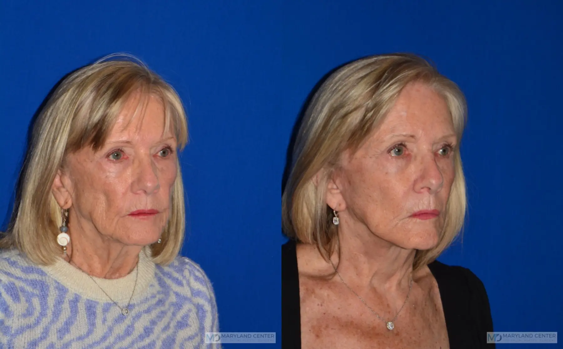 Neck Lift: Patient 4 - Before and After 3