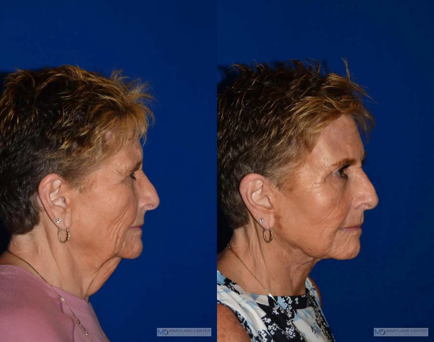 Neck Lift: Patient 1 - Before and After 2