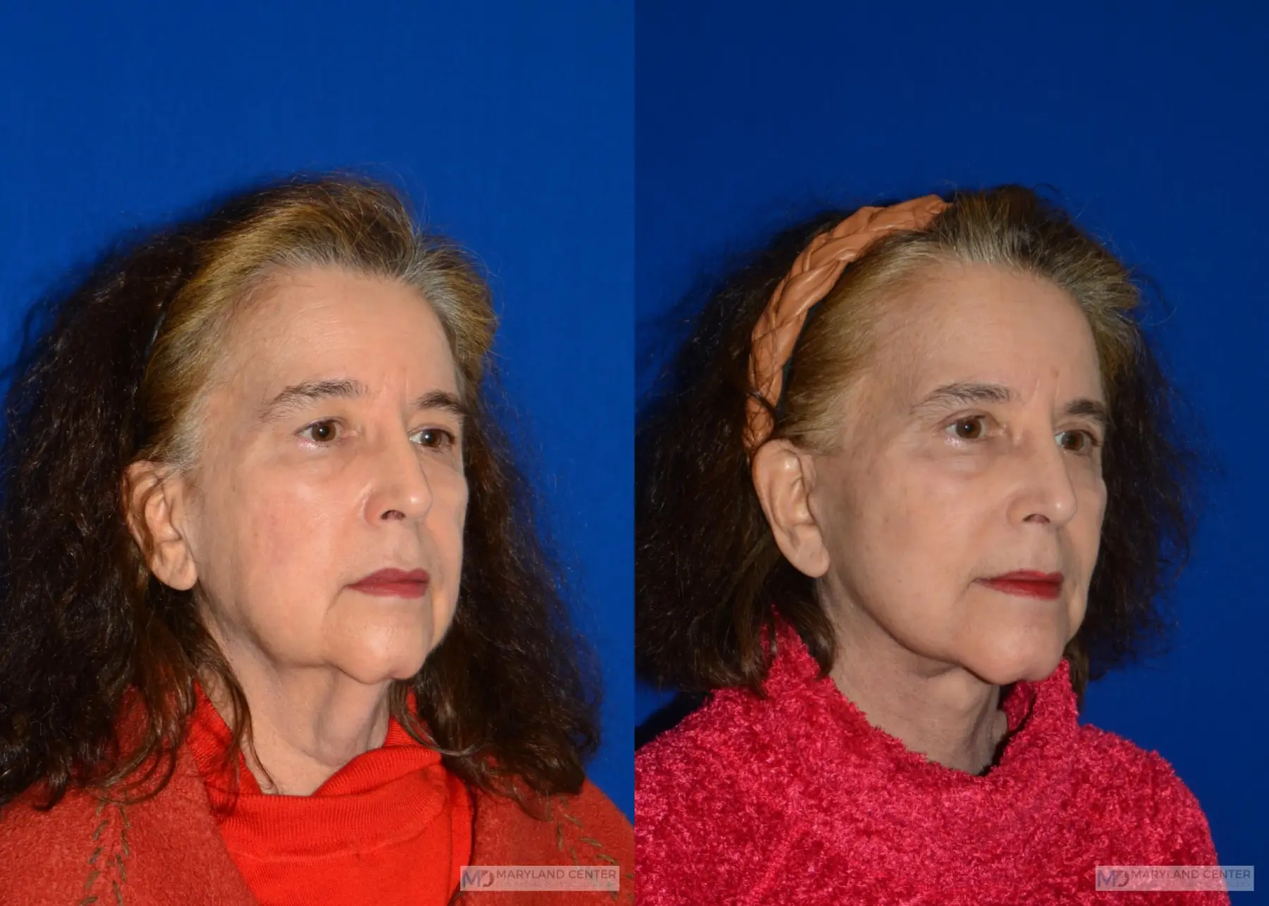 Neck Lift: Patient 2 - Before and After 3