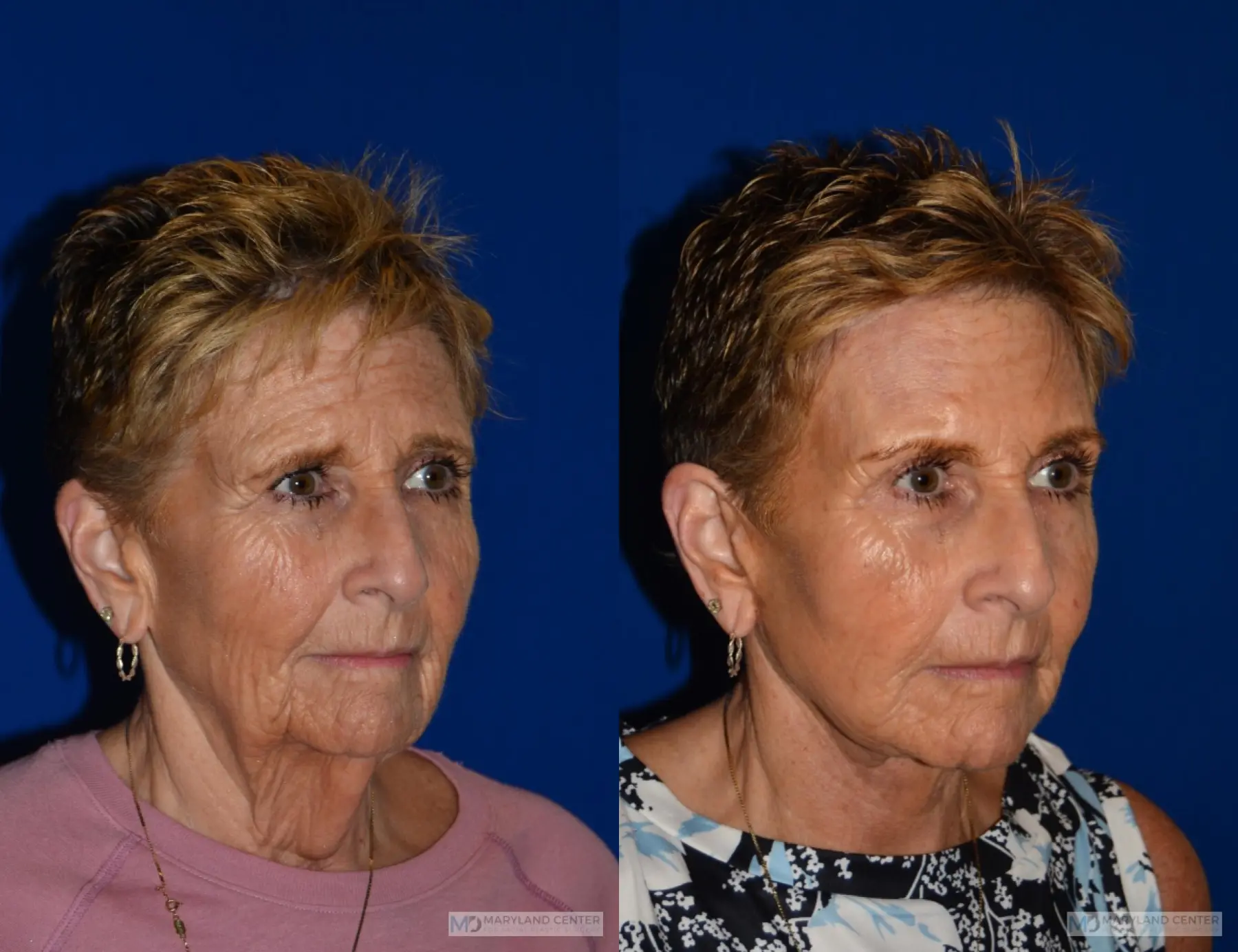 Neck Lift: Patient 1 - Before and After 3