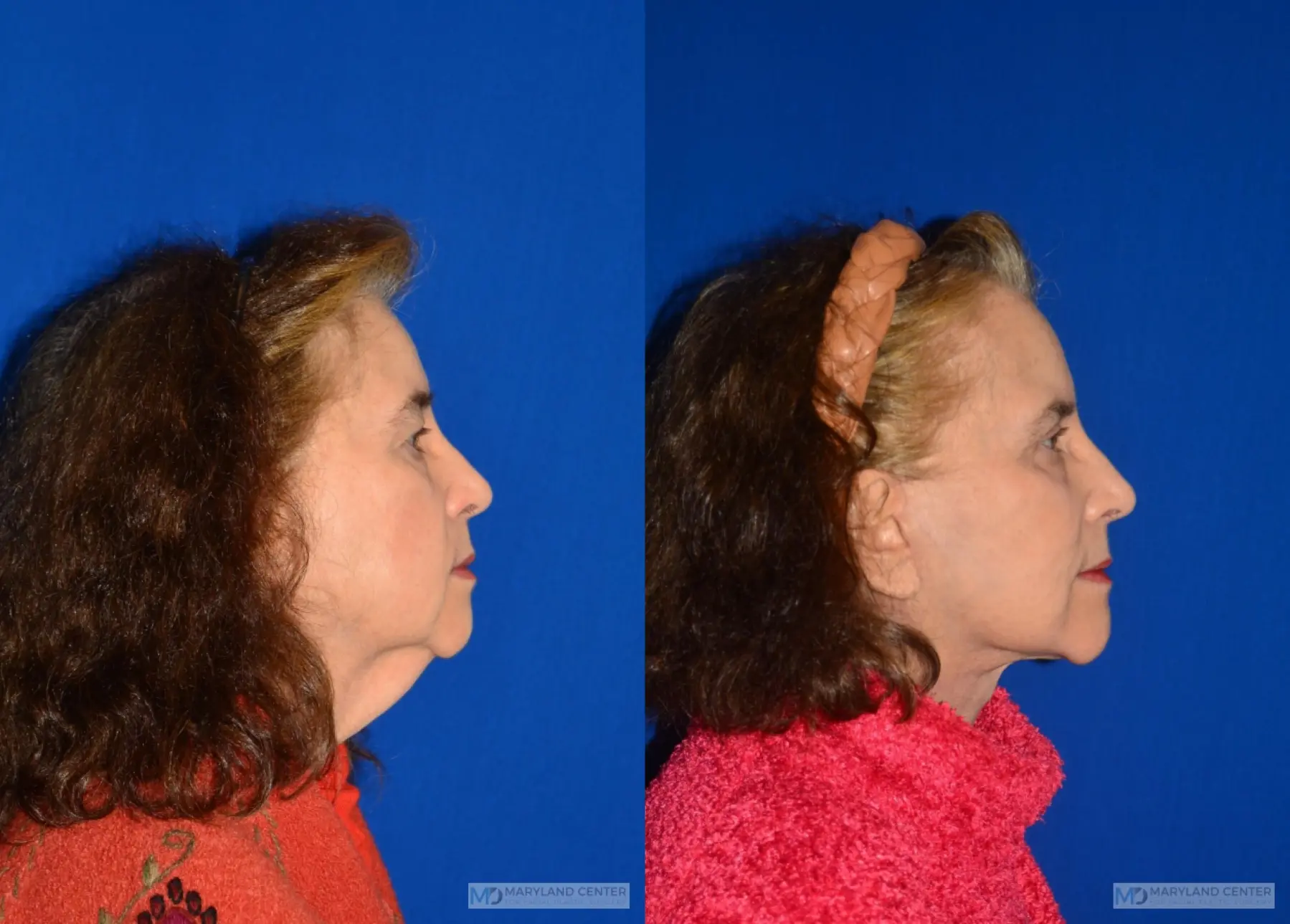 Neck Lift: Patient 2 - Before and After 2