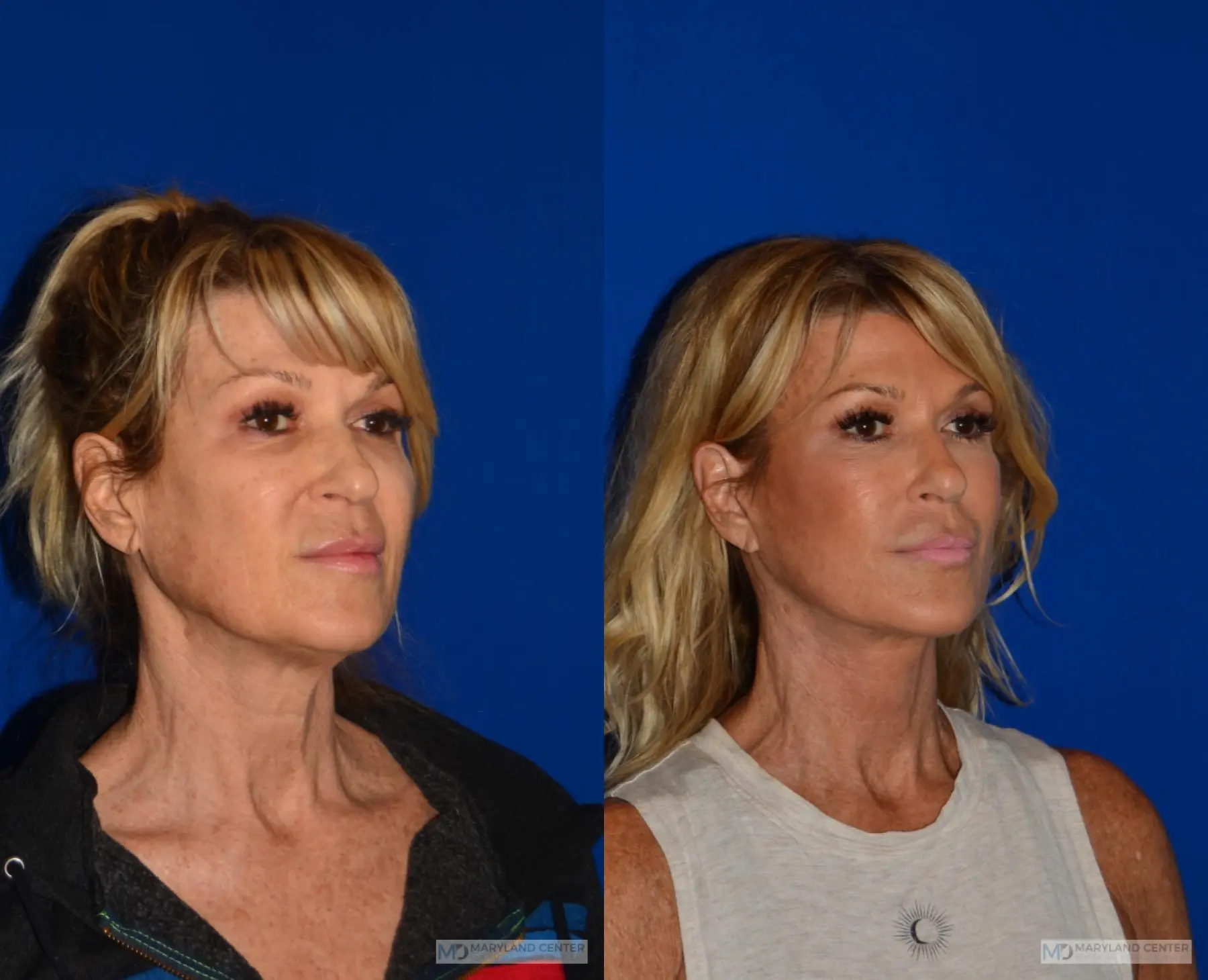 Neck Lift: Patient 5 - Before and After 3
