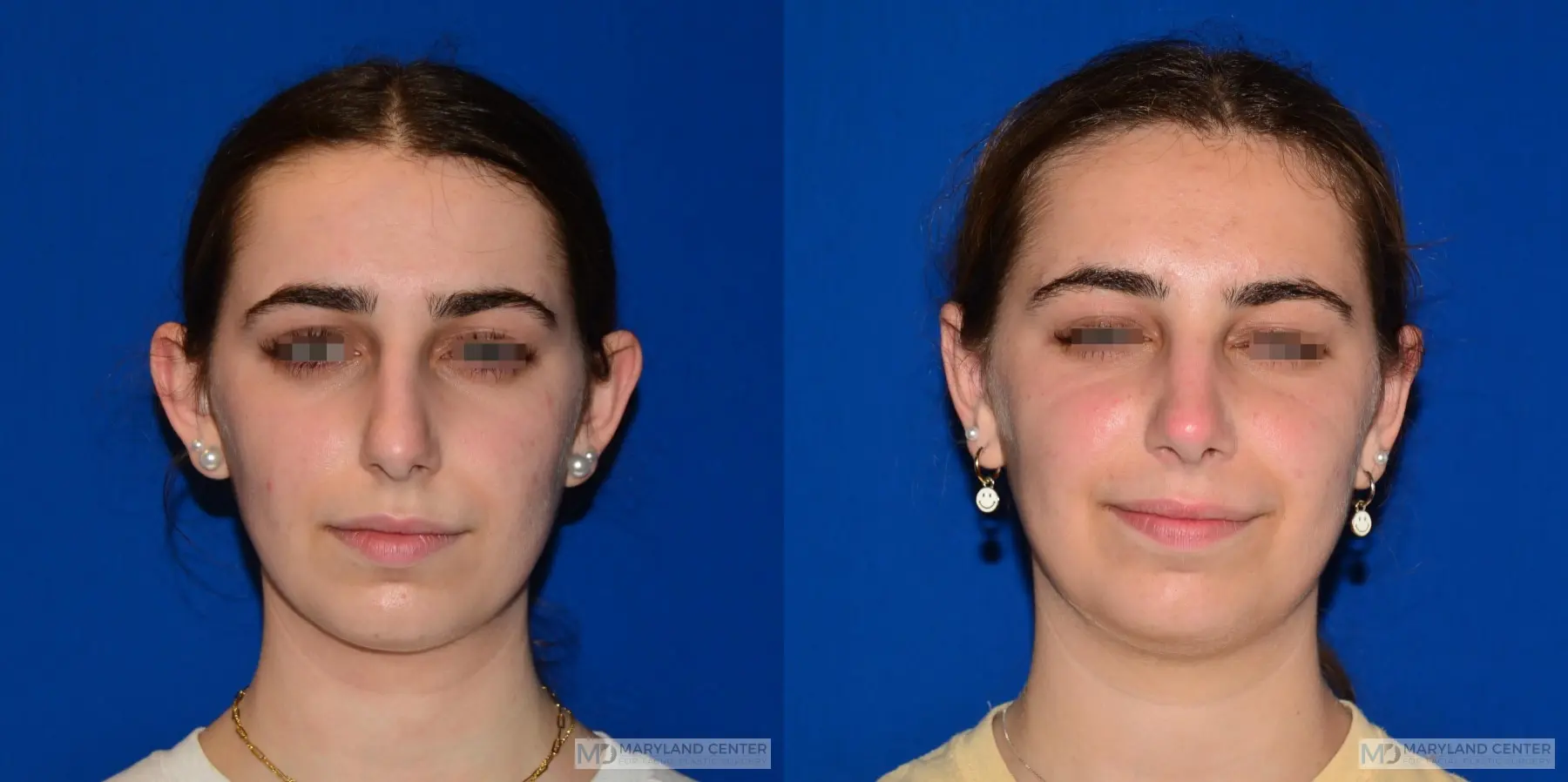 Otoplasty: Patient 1 - Before and After  