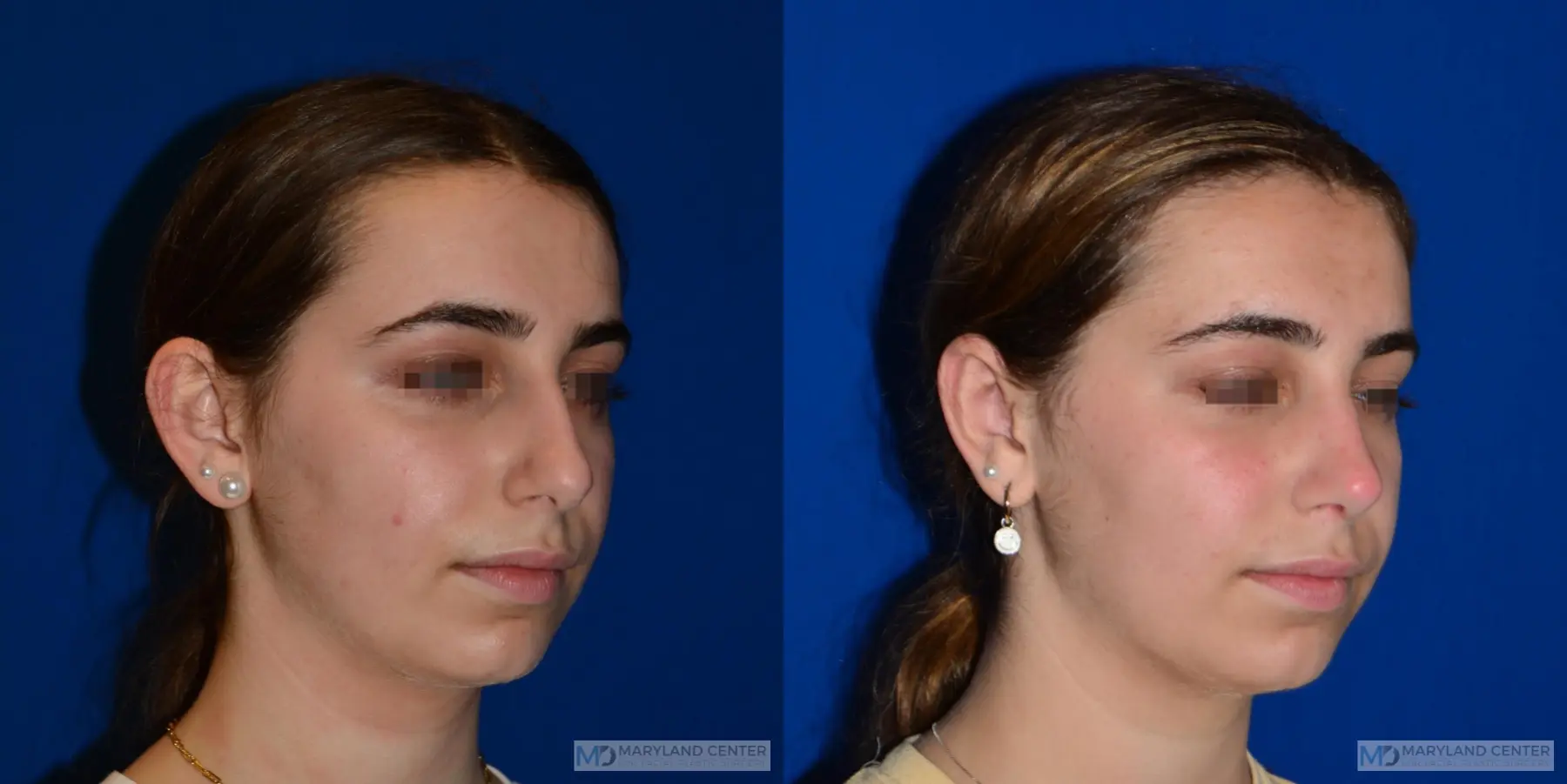 Otoplasty: Patient 1 - Before and After 2