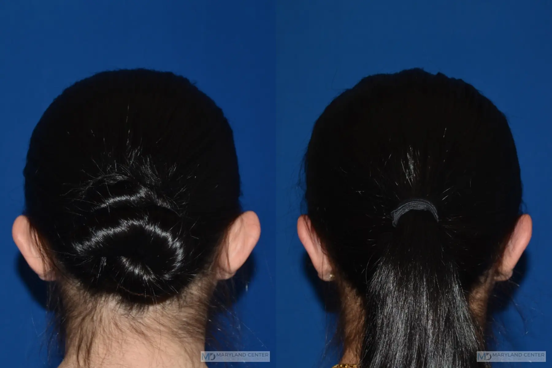 Otoplasty: Patient 3 - Before and After 2