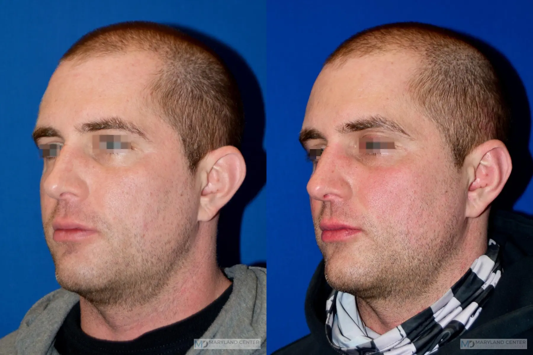 Otoplasty: Patient 2 - Before and After 4