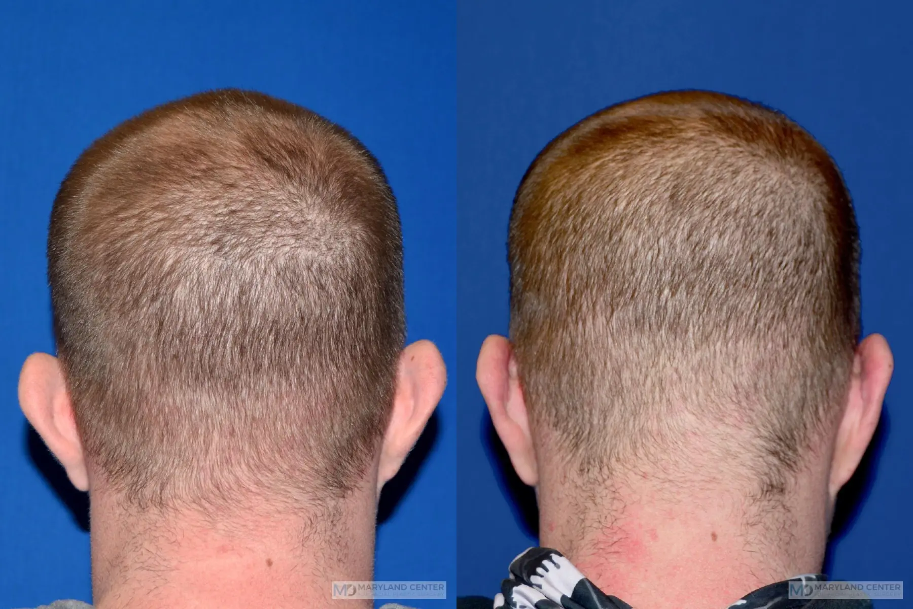 Otoplasty: Patient 2 - Before and After 3