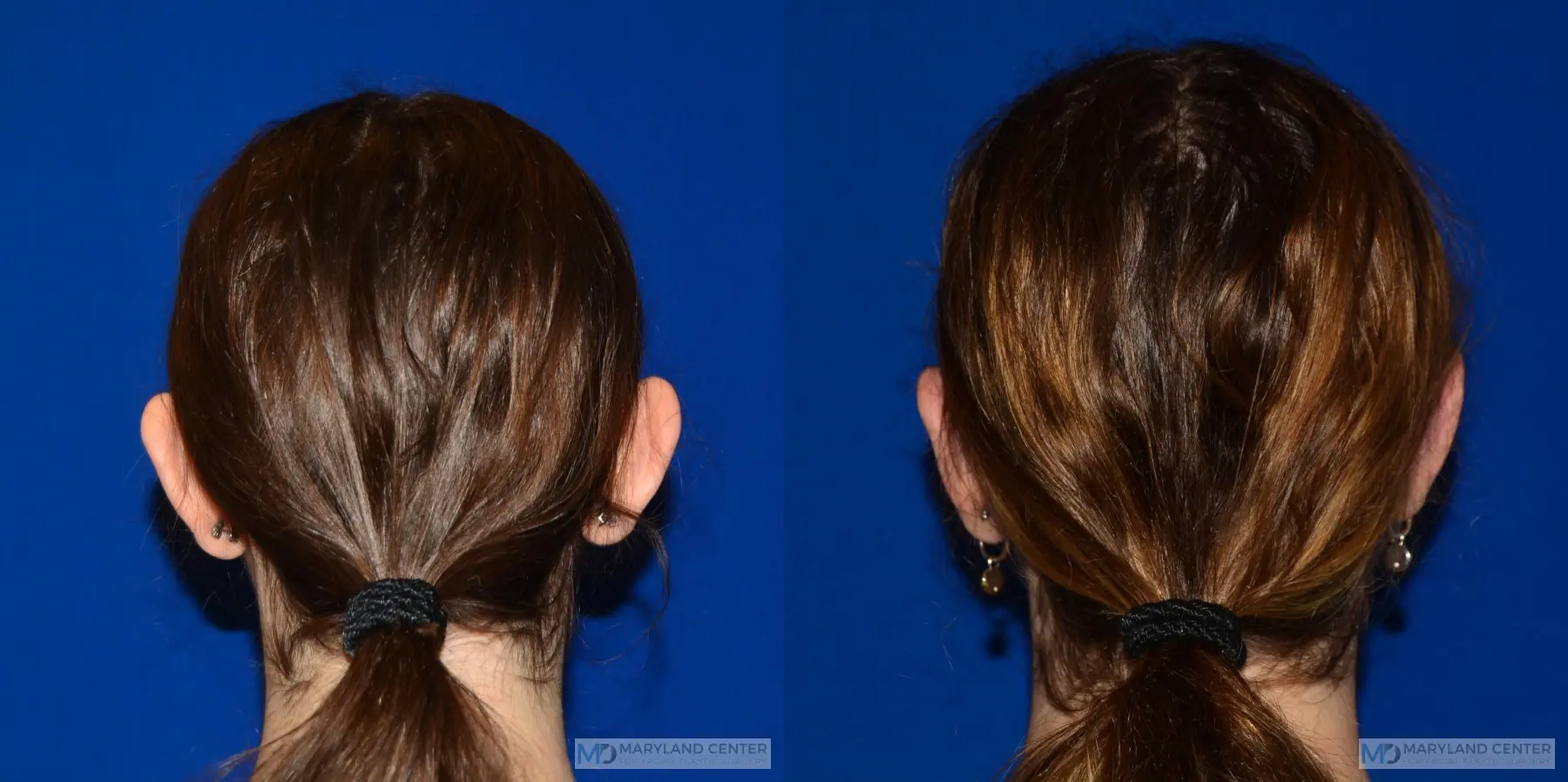 Otoplasty: Patient 1 - Before and After 4