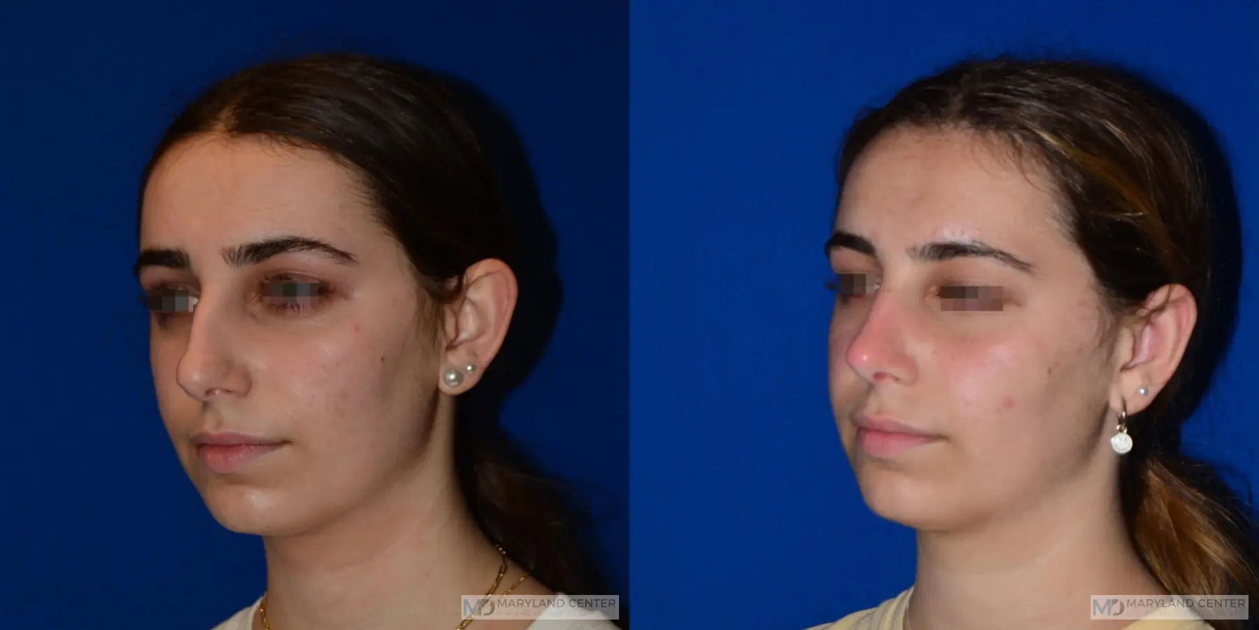 Otoplasty: Patient 1 - Before and After 3