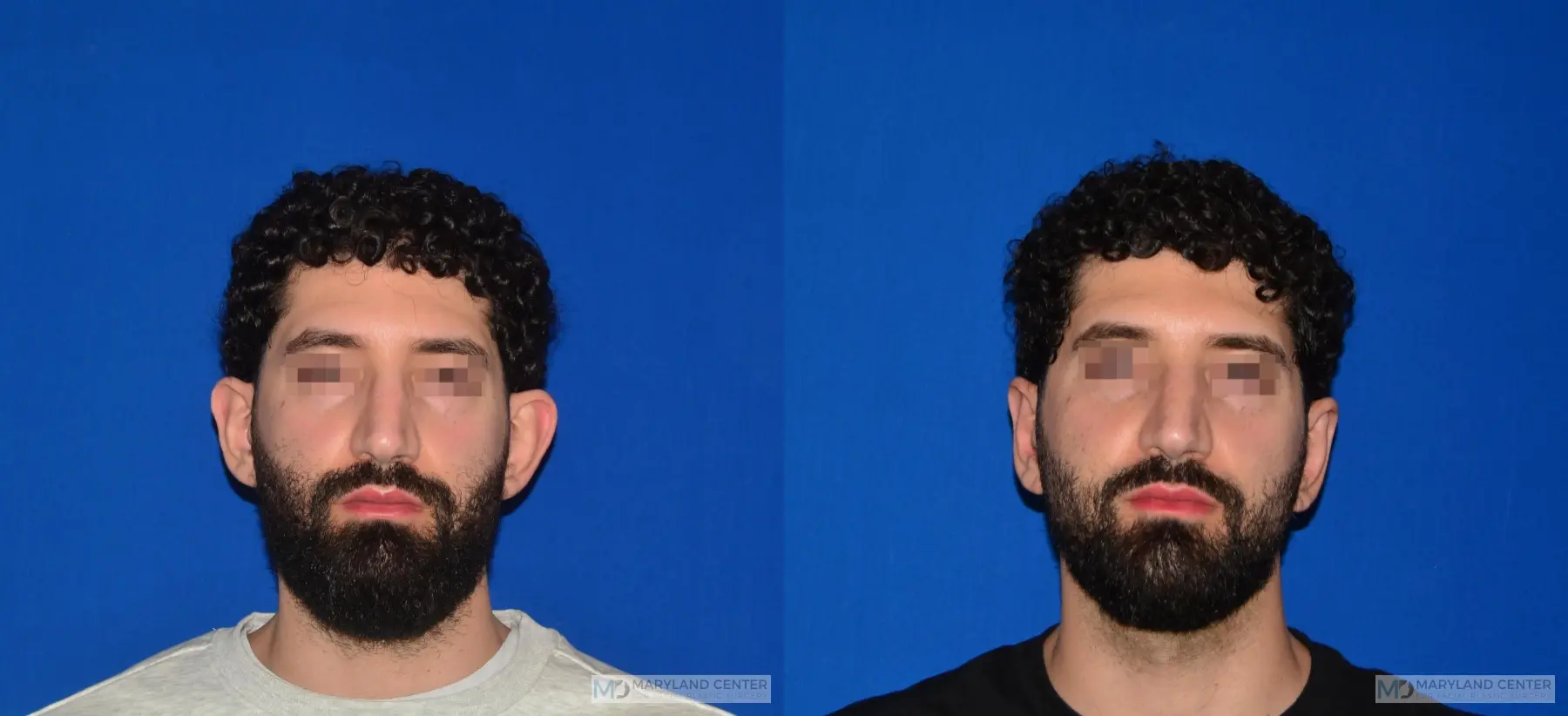 Otoplasty: Patient 5 - Before and After  
