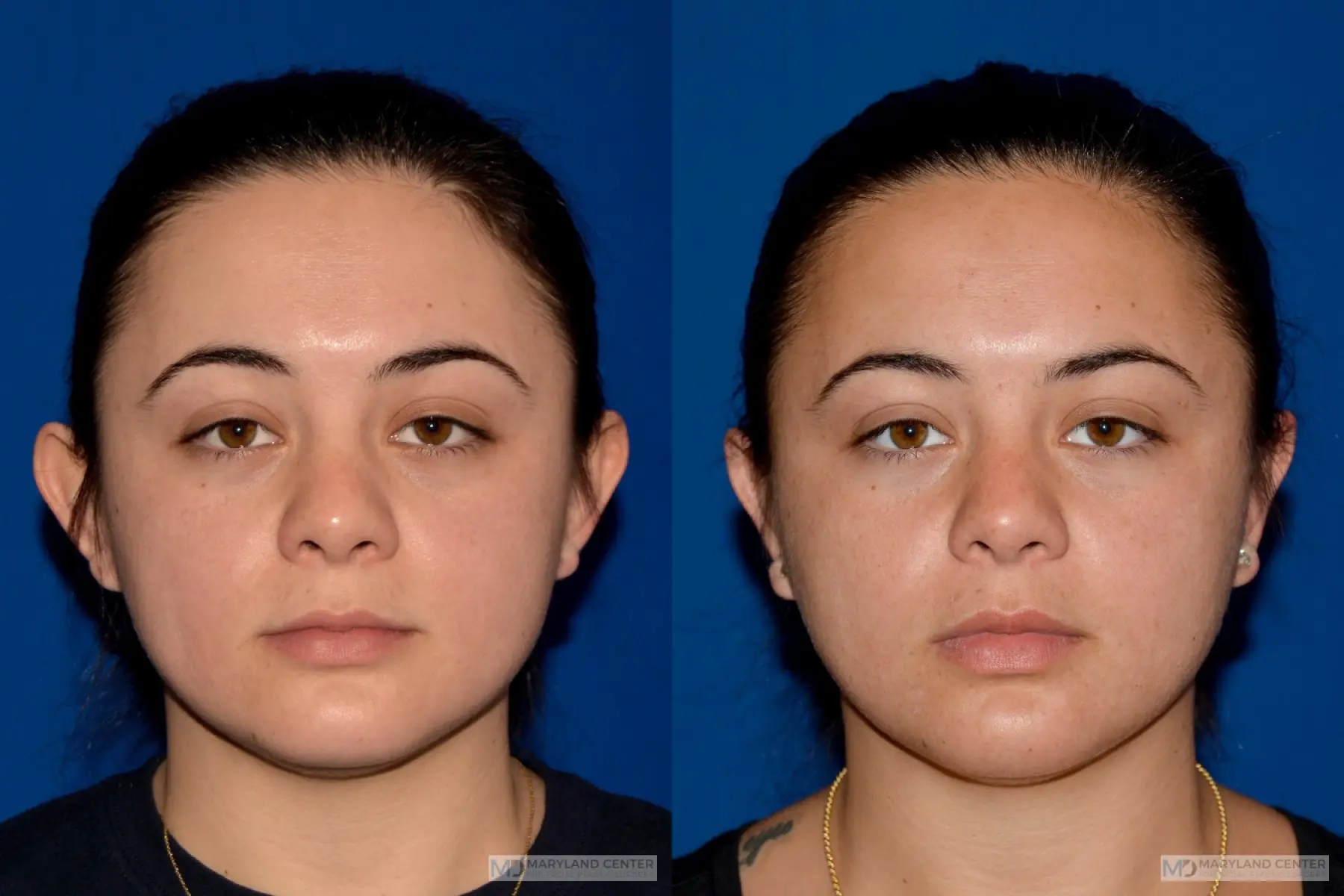 Otoplasty: Patient 4 - Before and After  