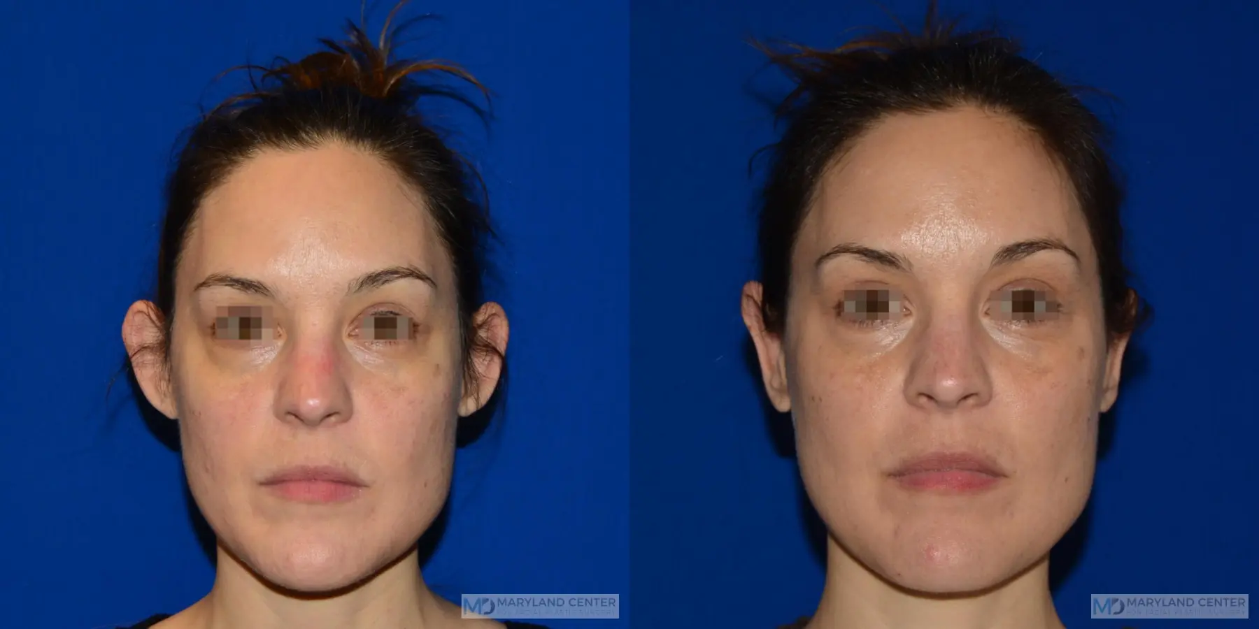 Otoplasty: Patient 4 - Before and After  