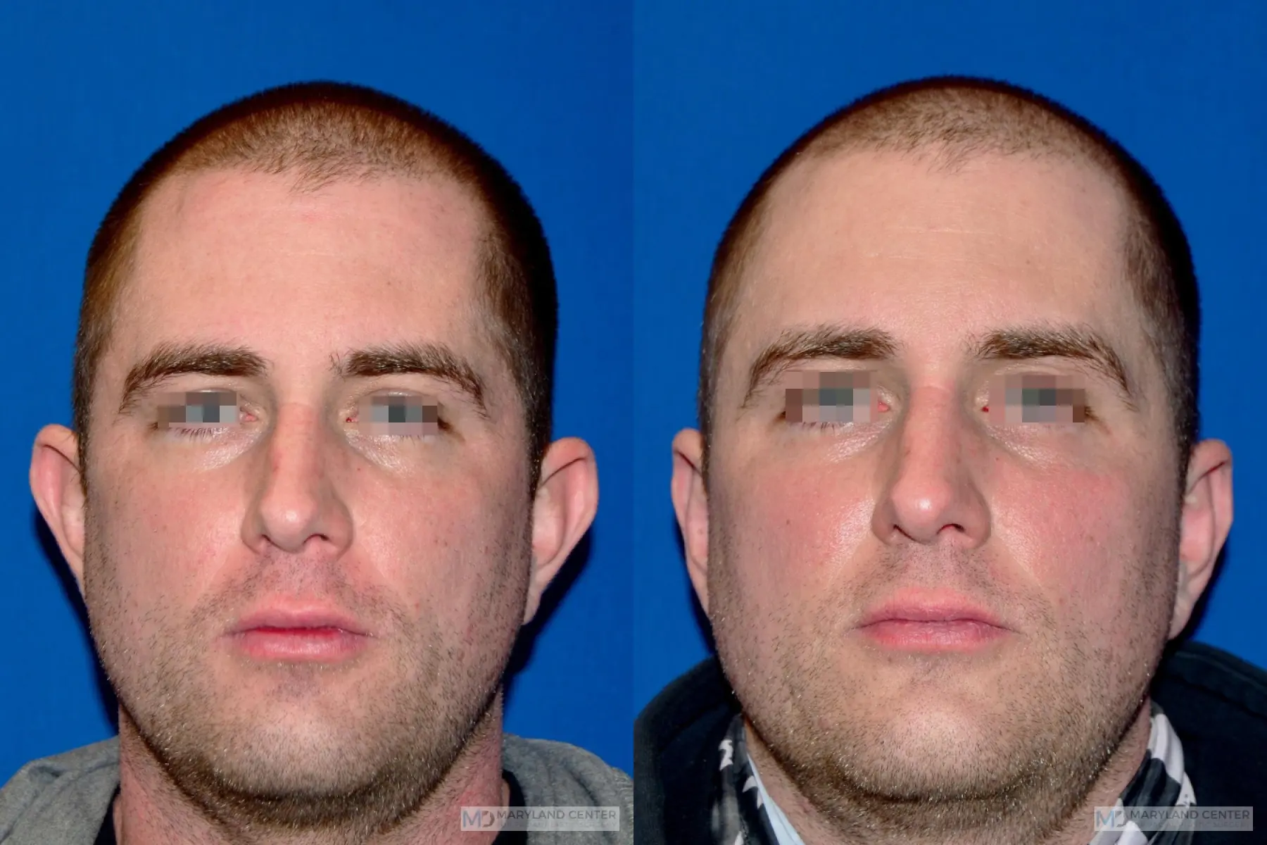 Otoplasty: Patient 2 - Before and After  