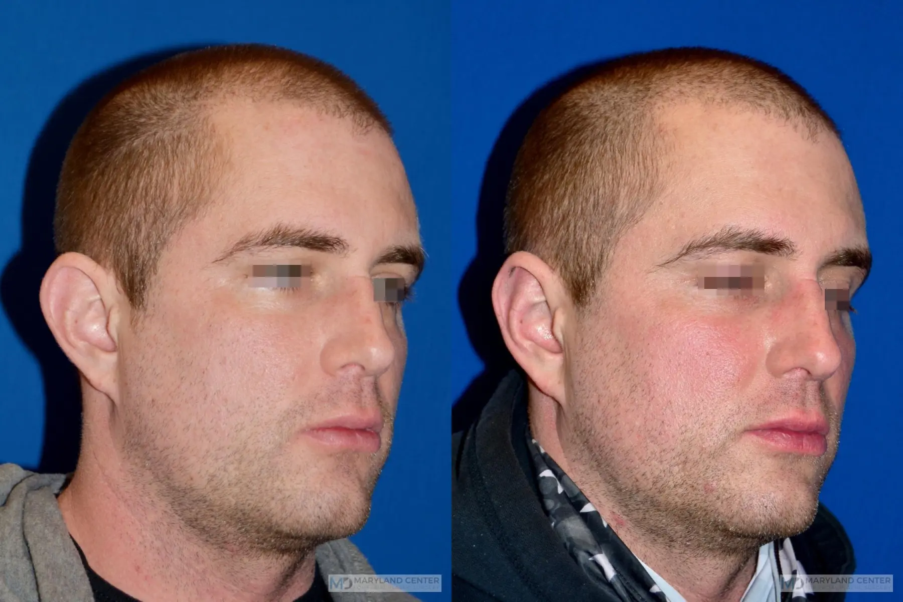 Otoplasty: Patient 2 - Before and After 2