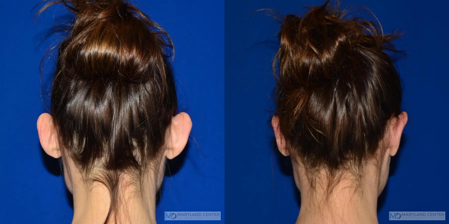 Otoplasty: Patient 4 - Before and After 2