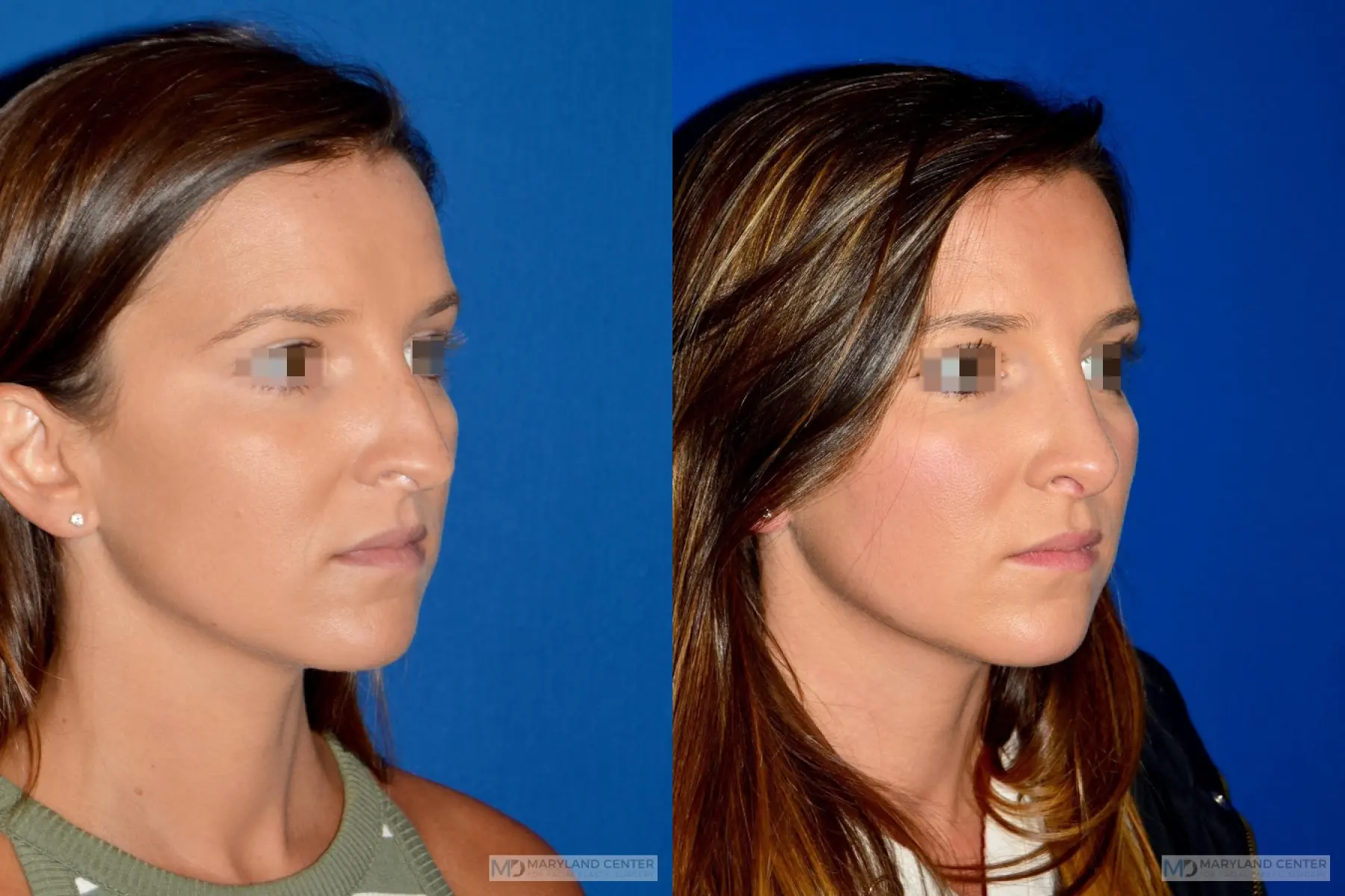 Rhinoplasty: Patient 11 - Before and After 3