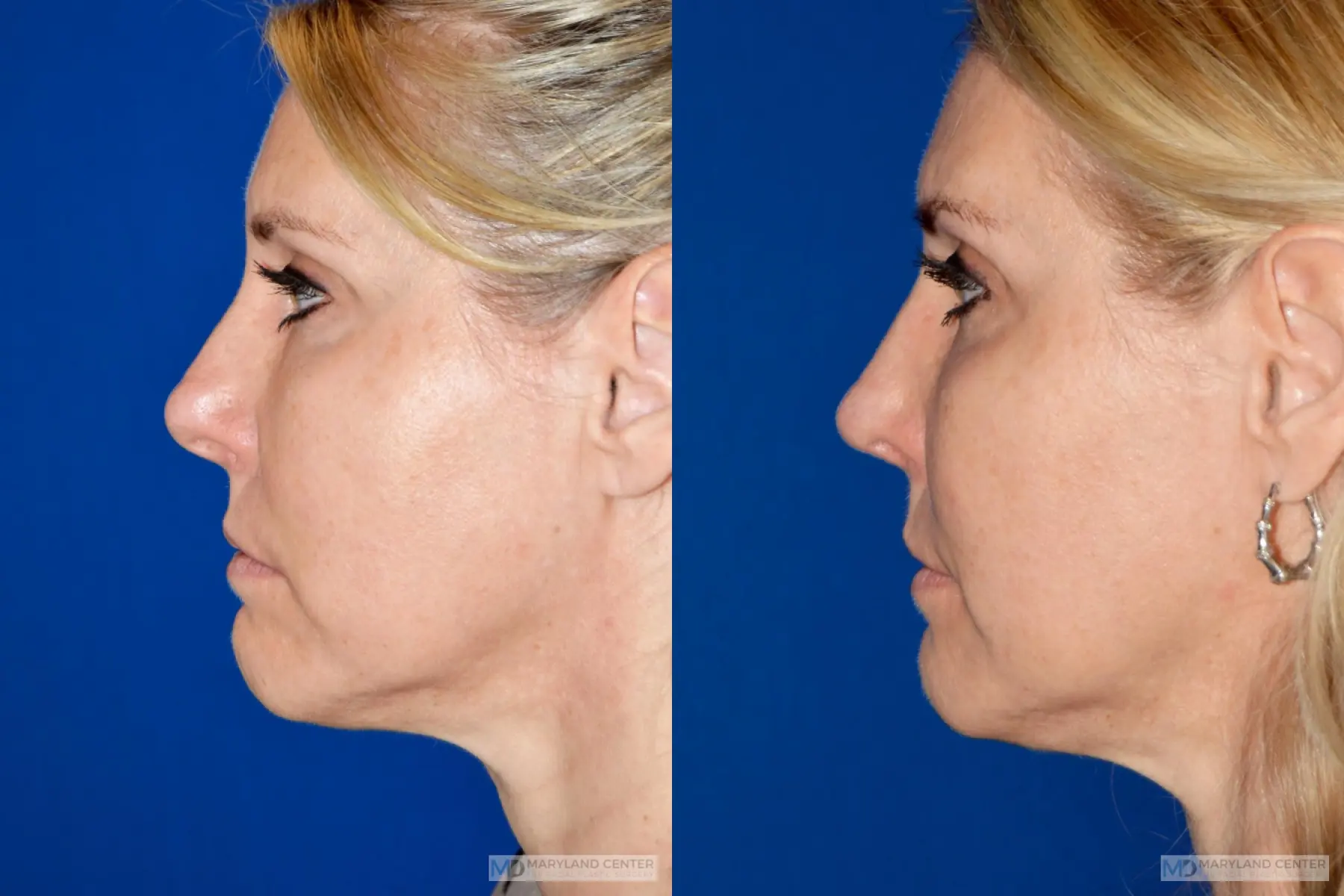 Rhinoplasty: Patient 15 - Before and After 2