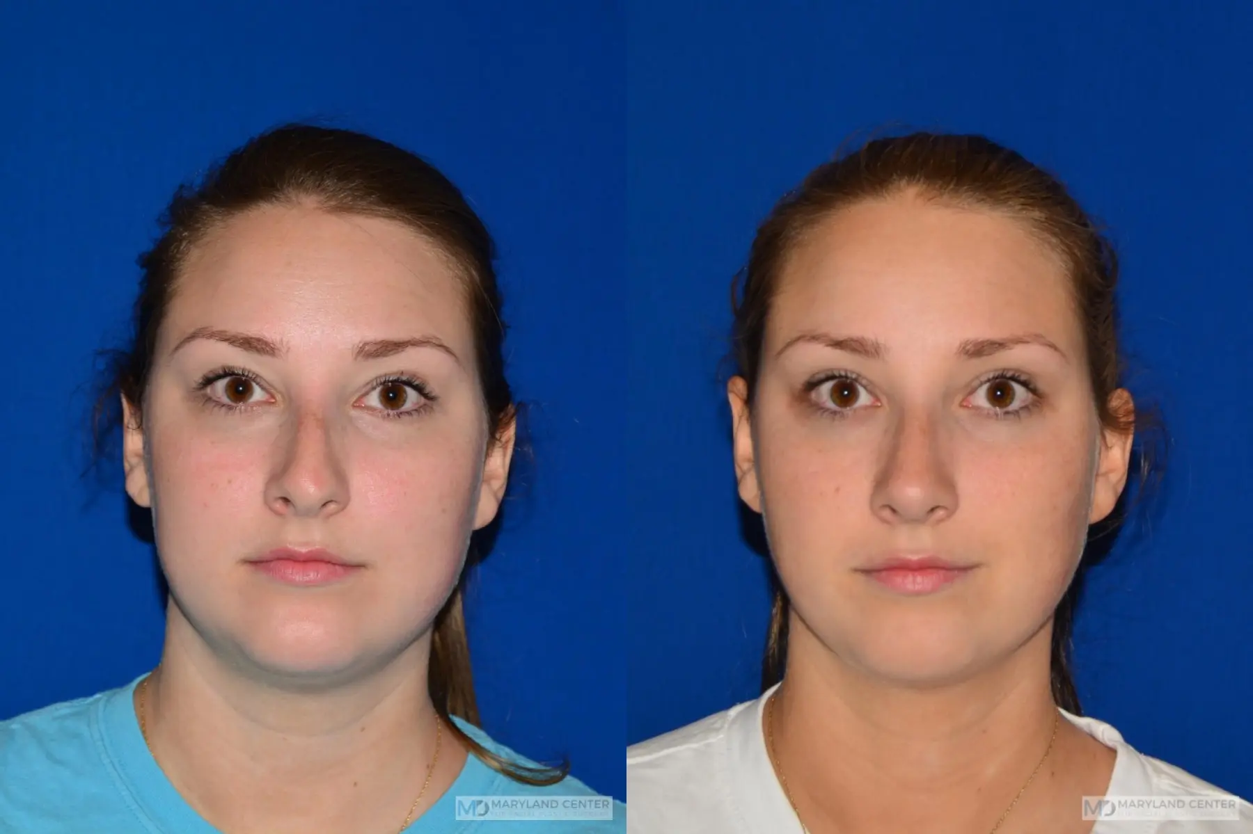 Rhinoplasty: Patient 1 - Before and After  