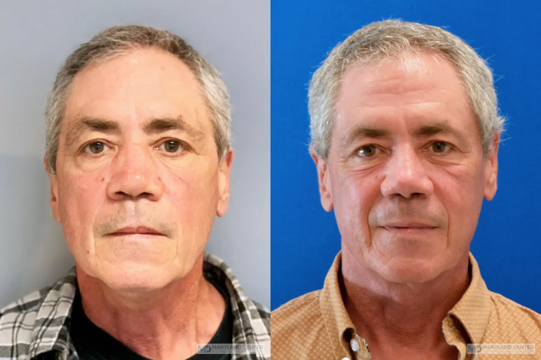 Rhinoplasty: Patient 20 - Before and After 1