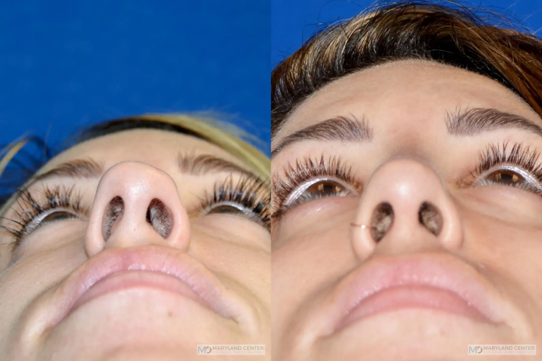Rhinoplasty: Patient 19 - Before and After 4